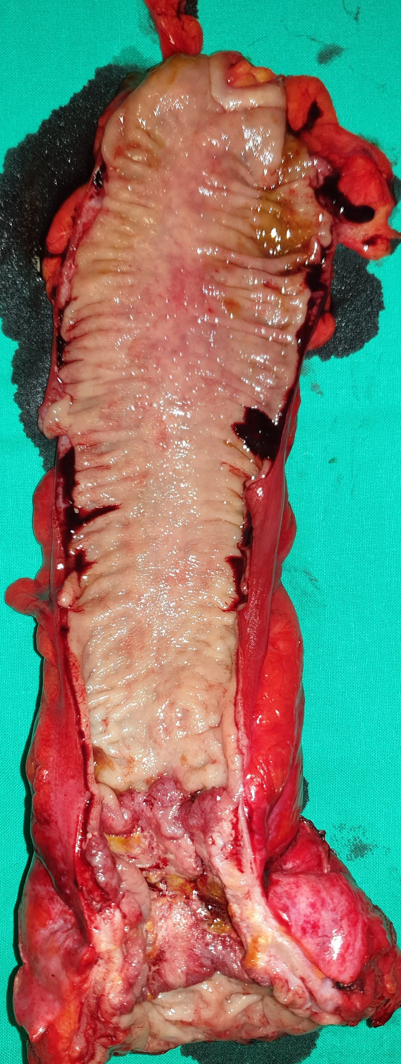 RECTAL CARCINOMA