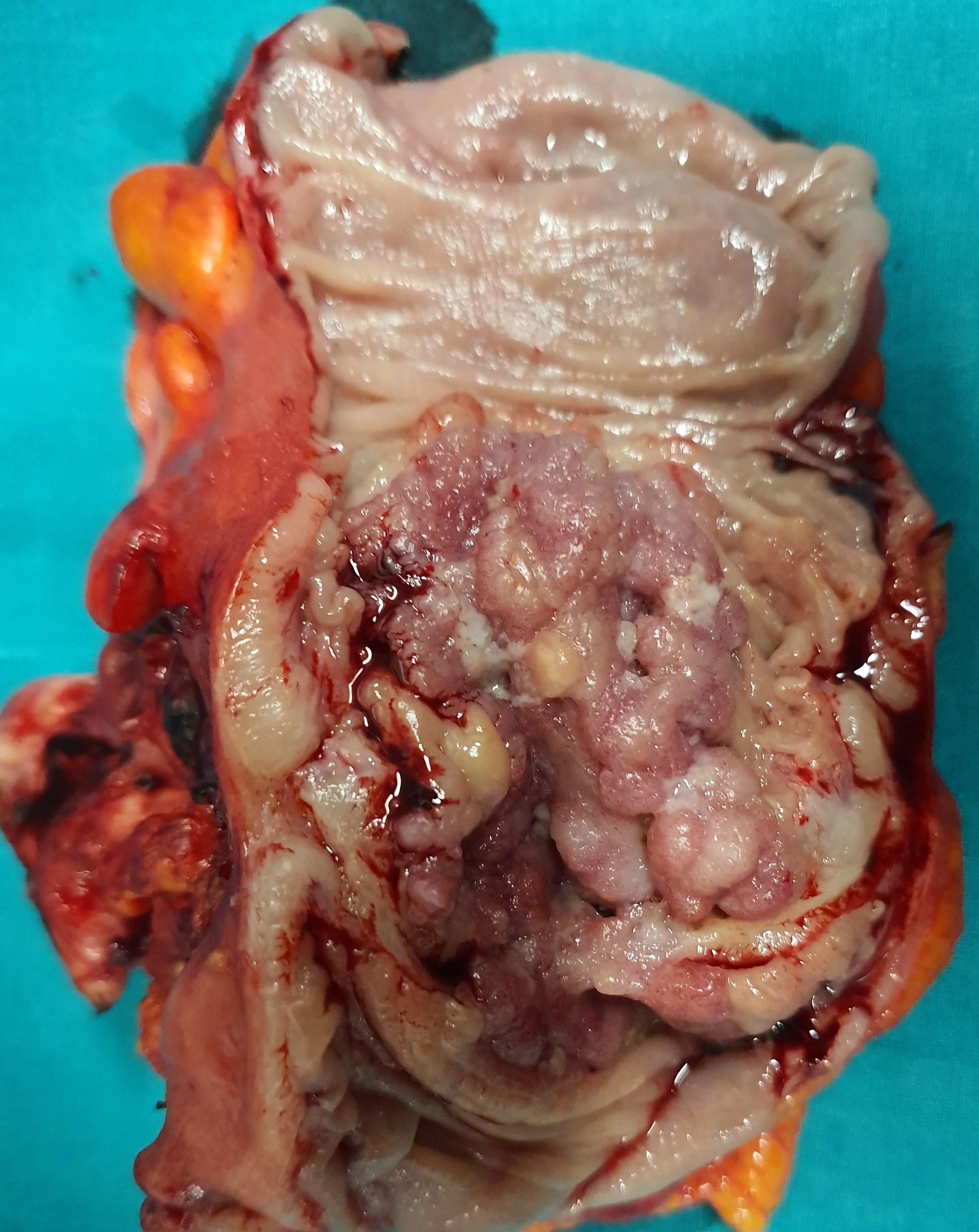 SIGMOID CARCINOMA