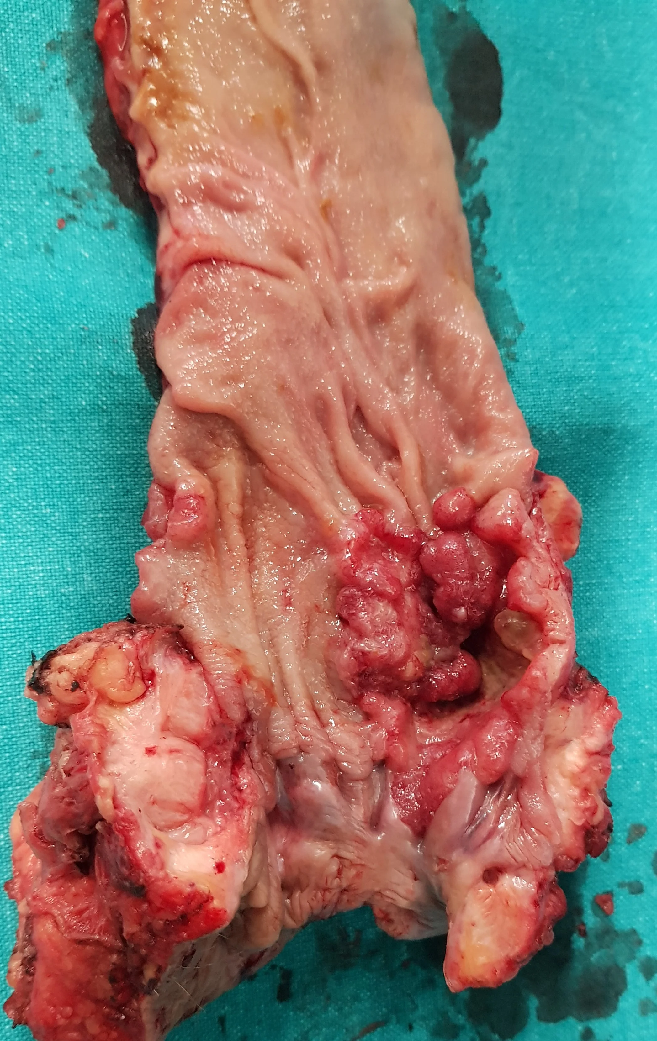 RECTAL CARCINOMA