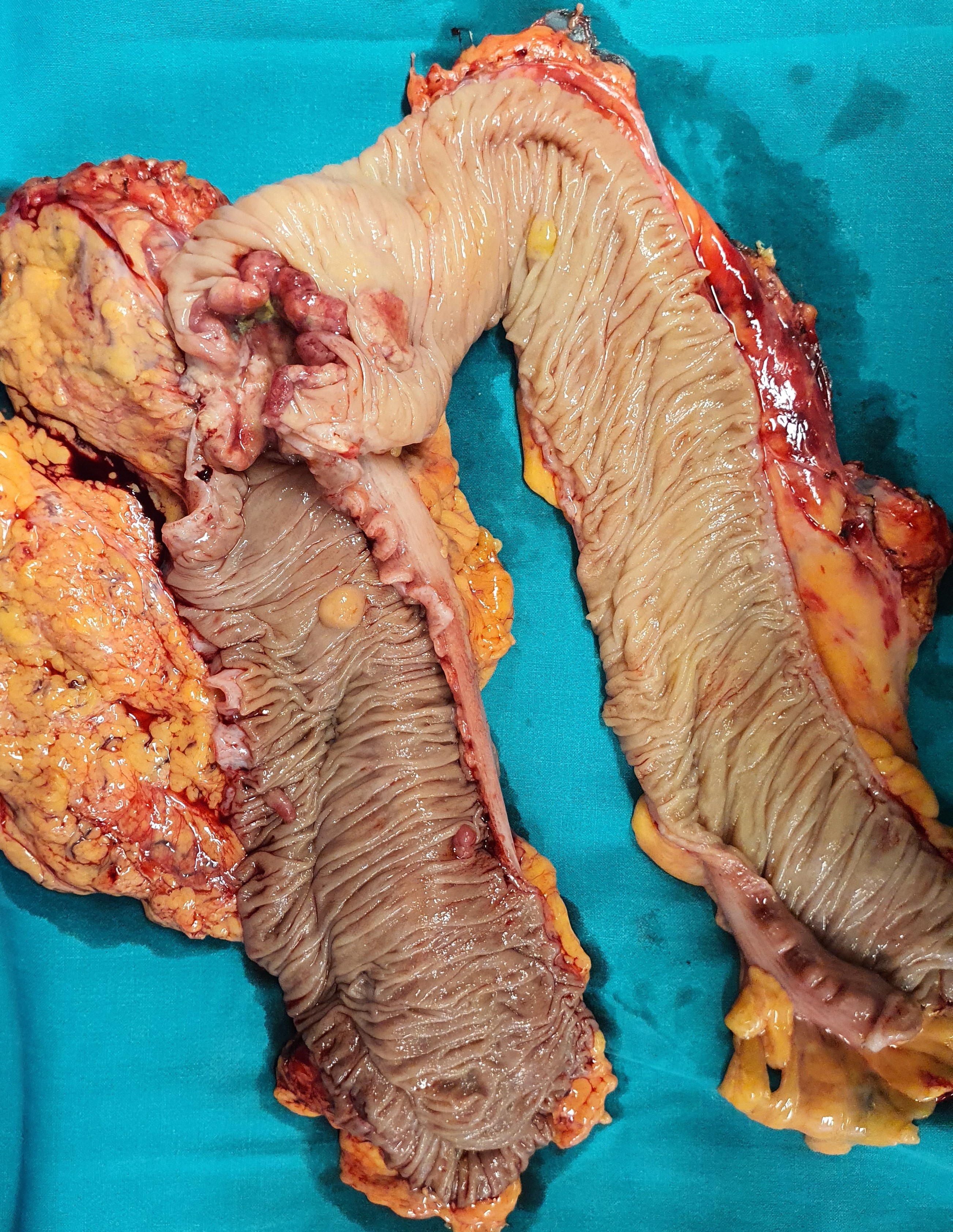 TRANSVERSE COLON CARCINOMA