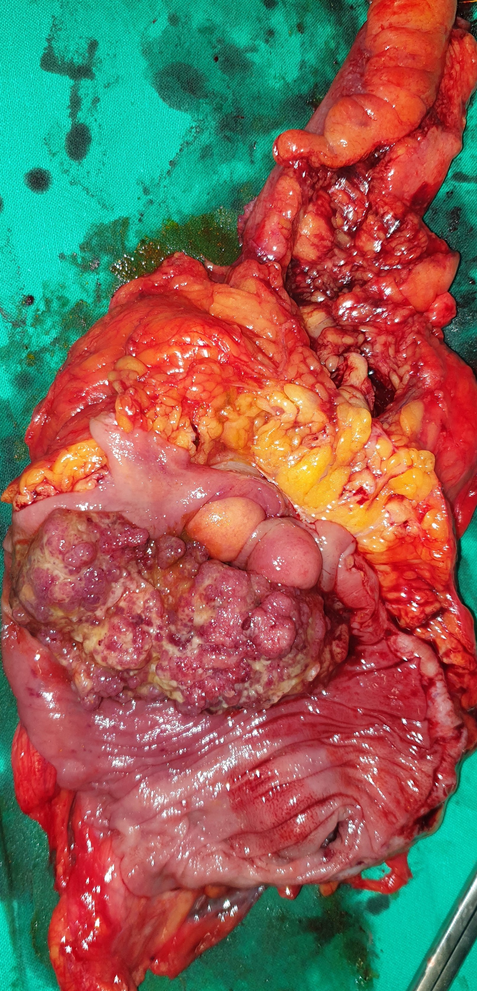 CECAL CARCINOMA