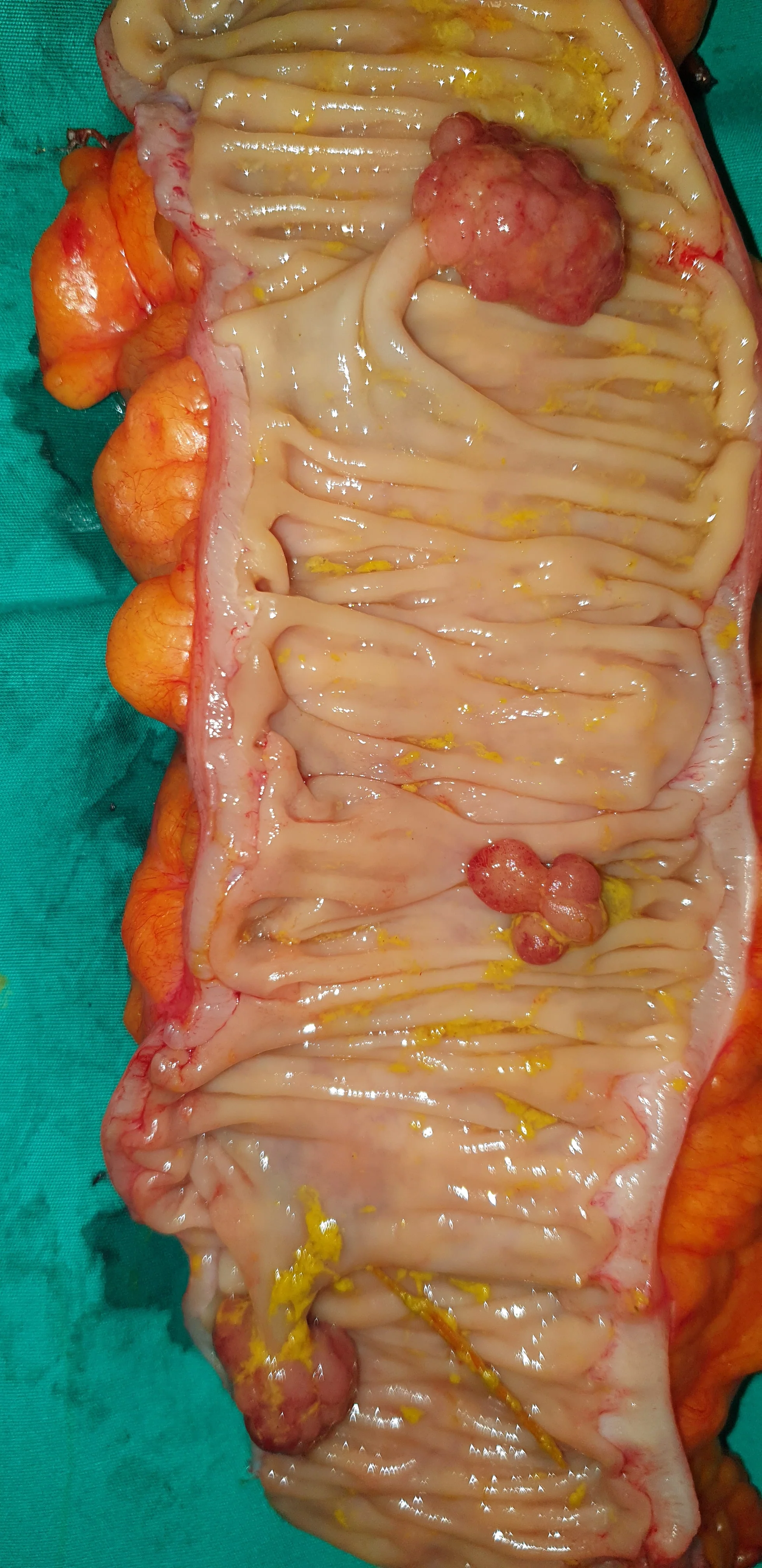 COLONIC POLYPS
