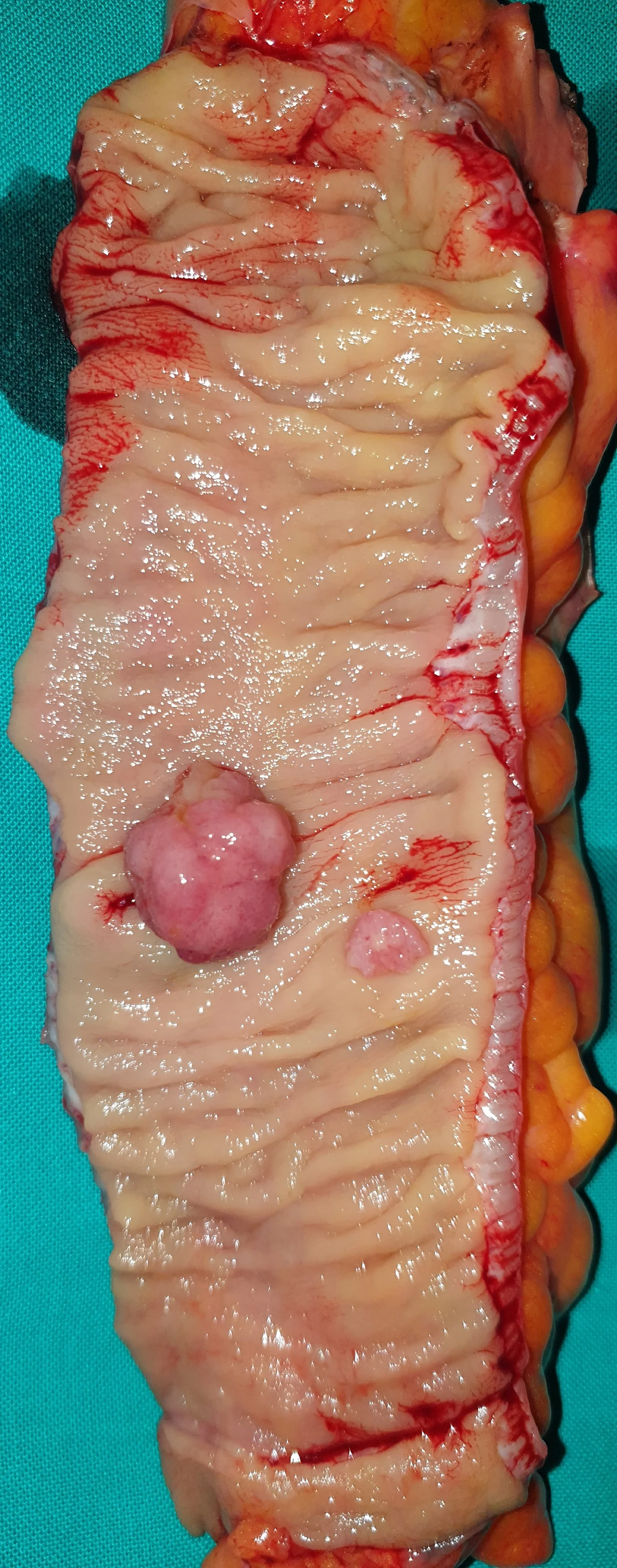 DESCENDING COLON CARCINOMA