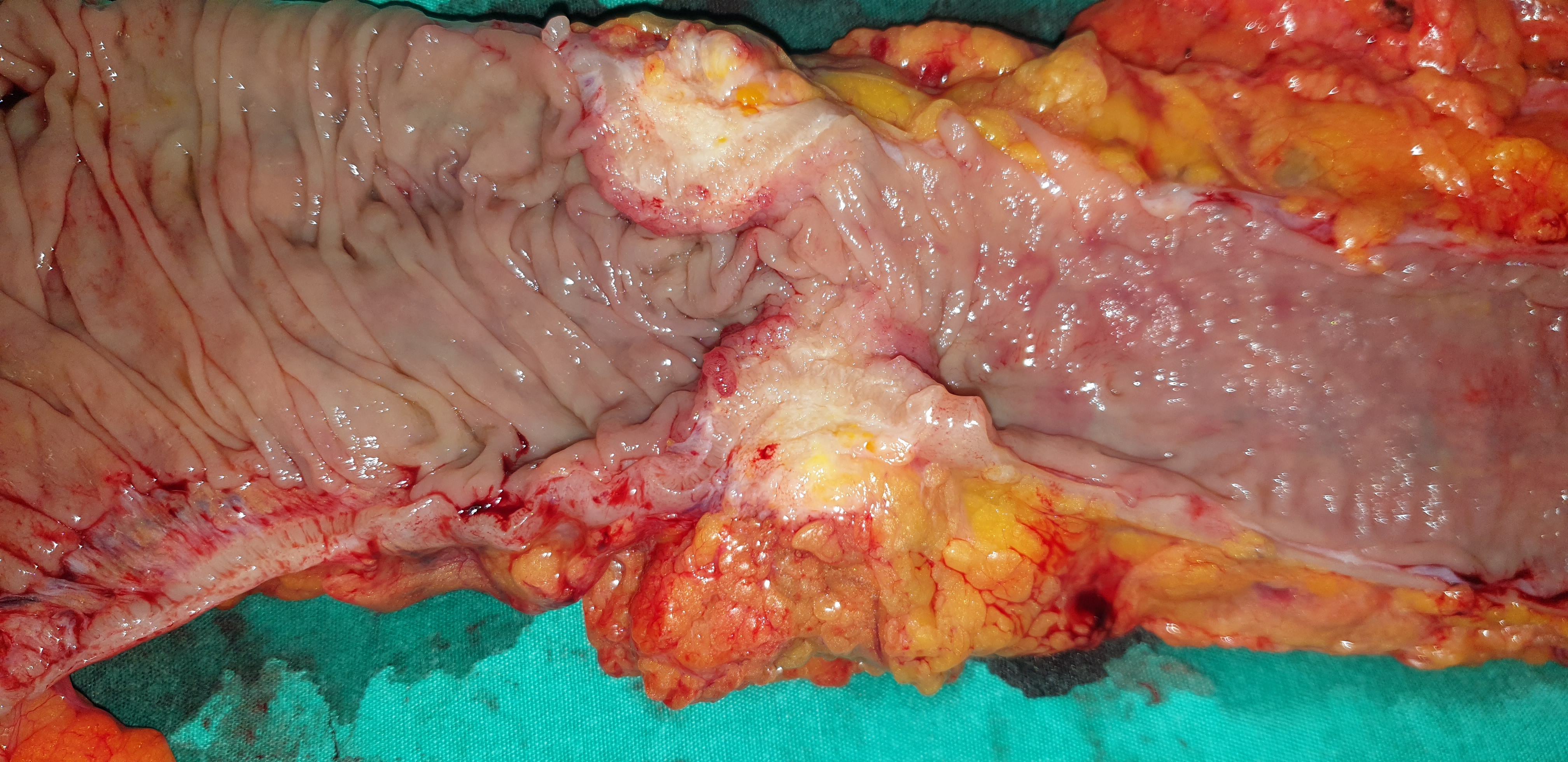 ASCENDING COLON CARCINOMA