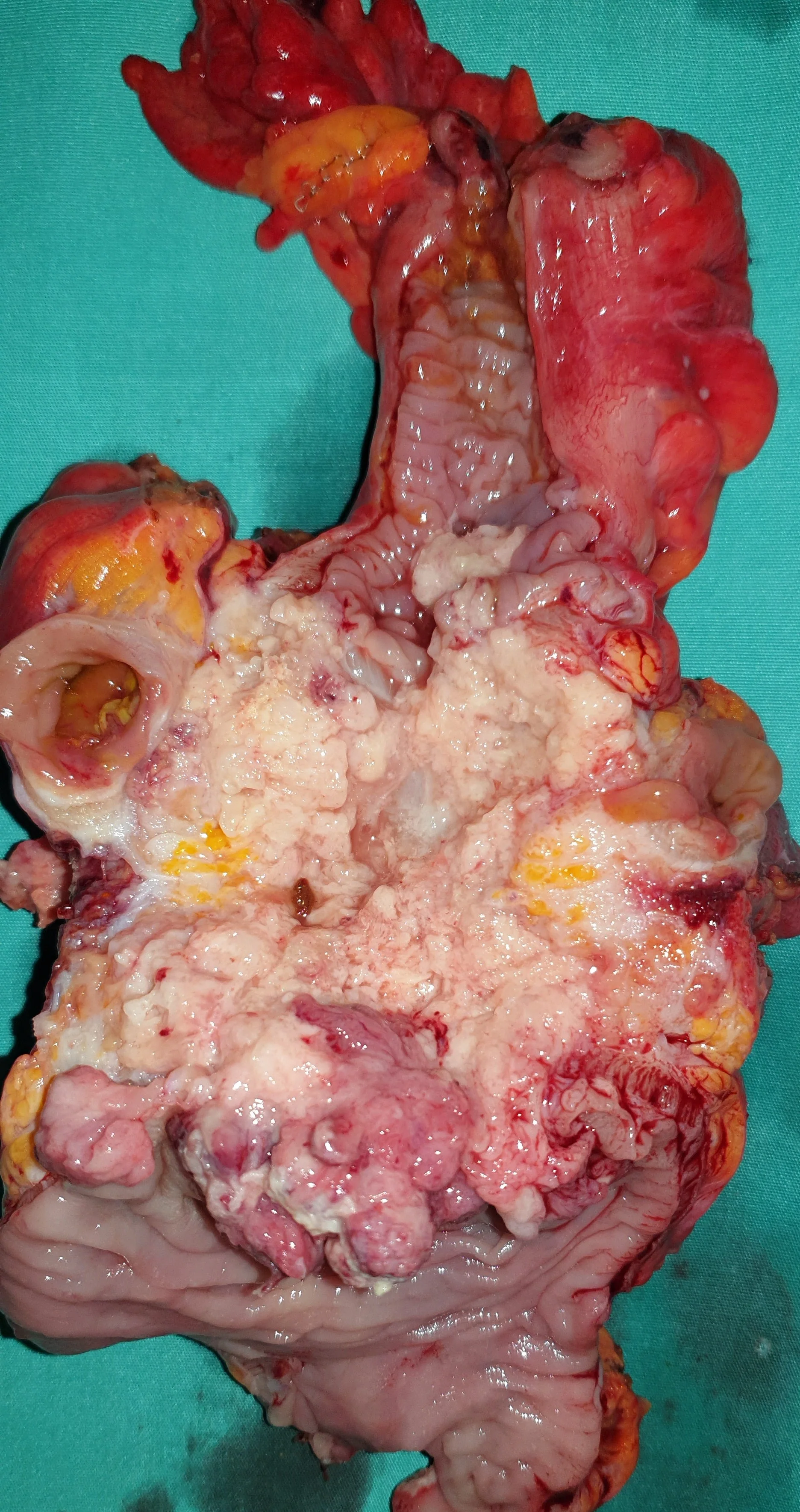 RECTAL CARCINOMA