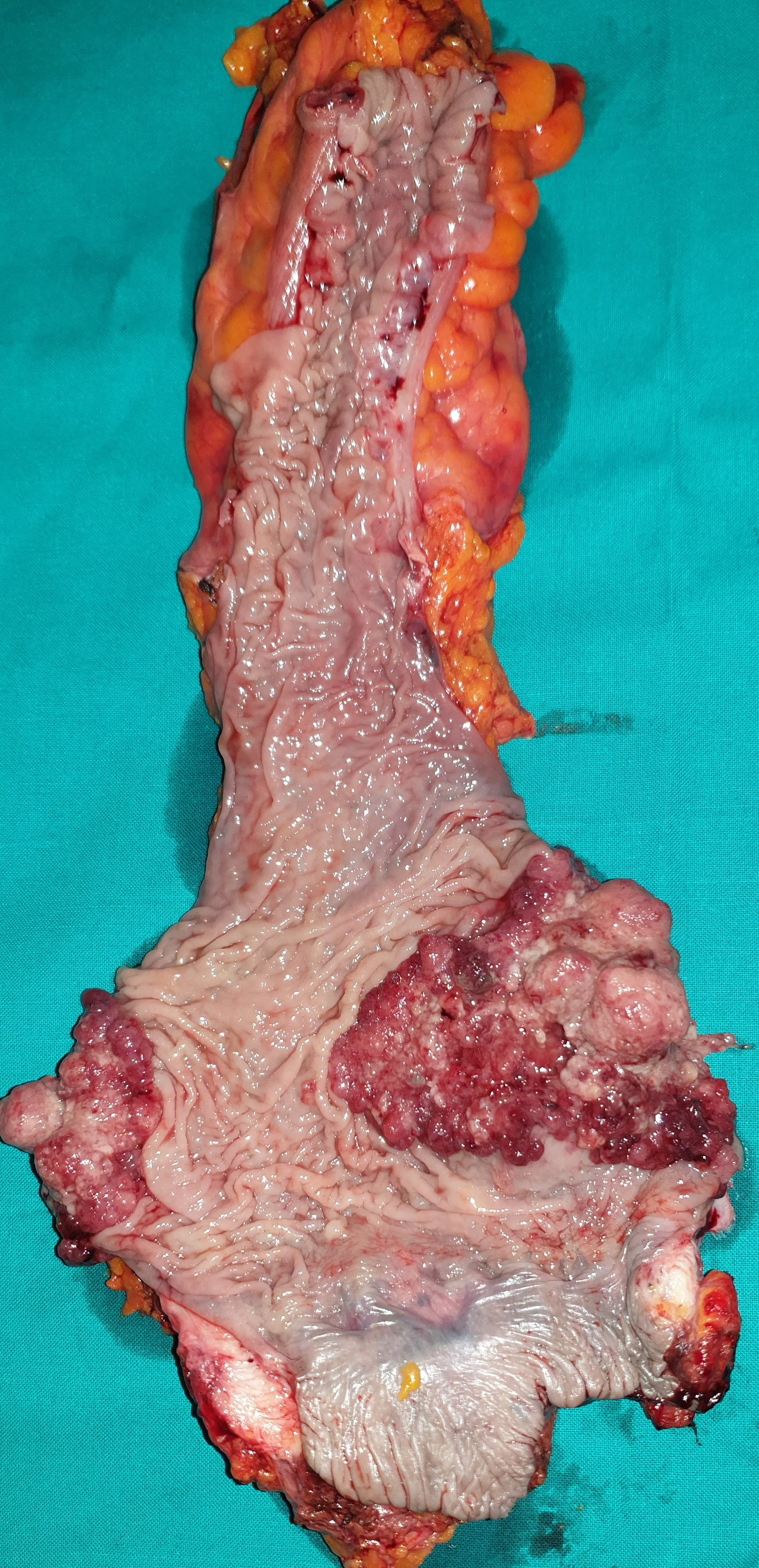 RECTAL CARCINOMA