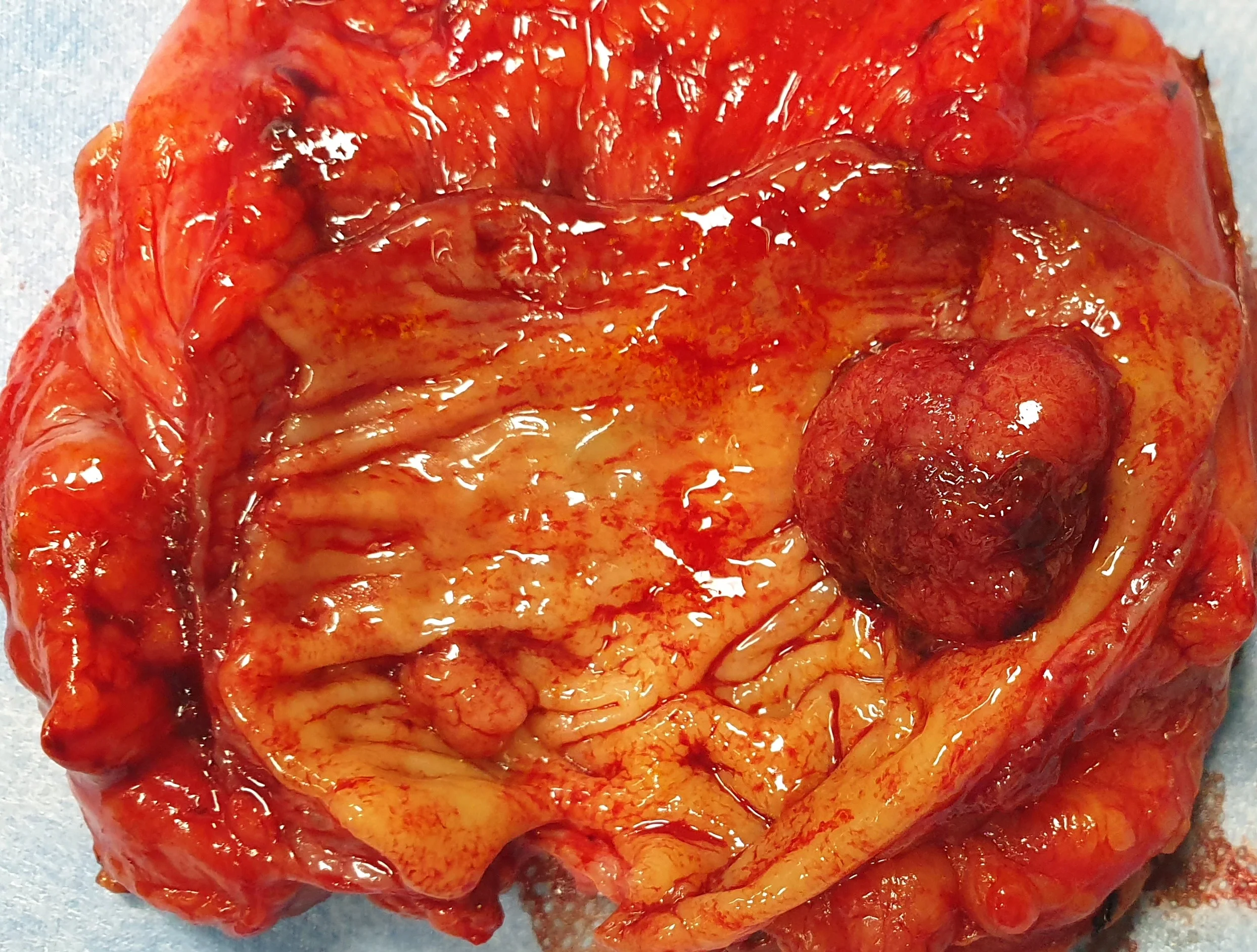 RECTAL CARCINOMA