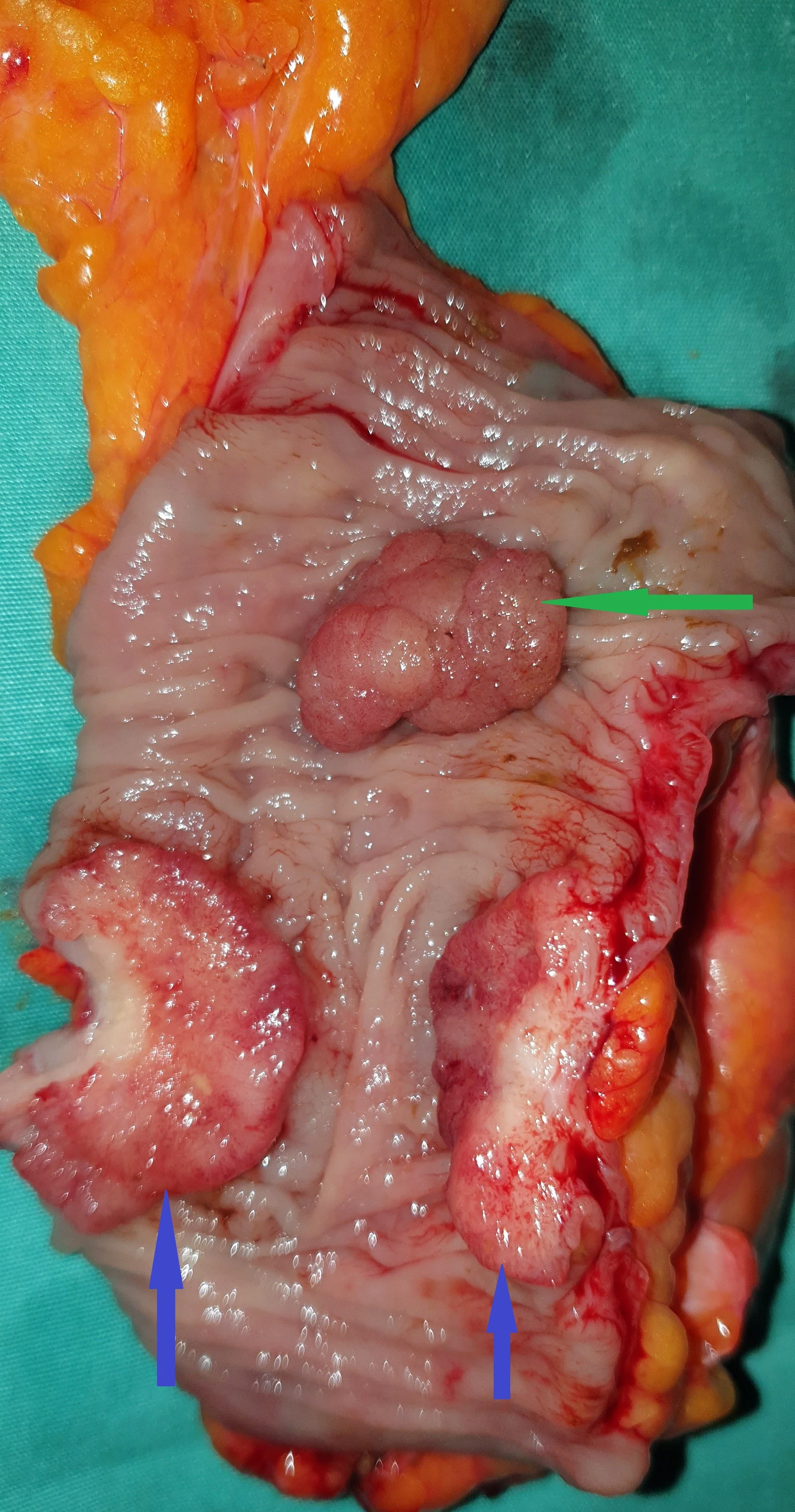 SYNCHRONOUS SIGMOID CARCINOMAS