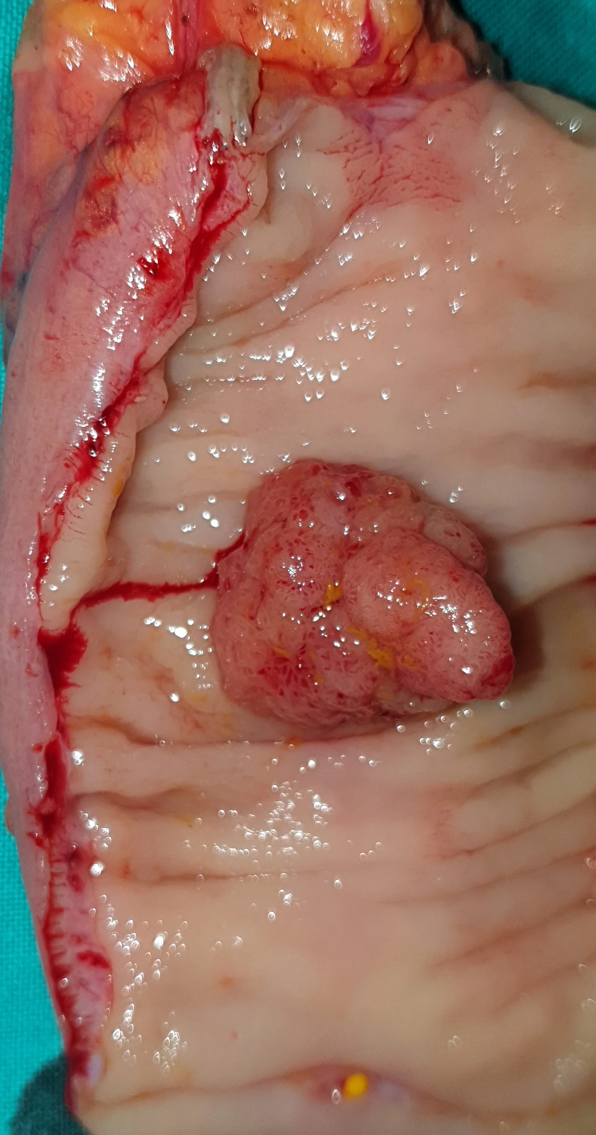 SIGMOID CARCINOMA