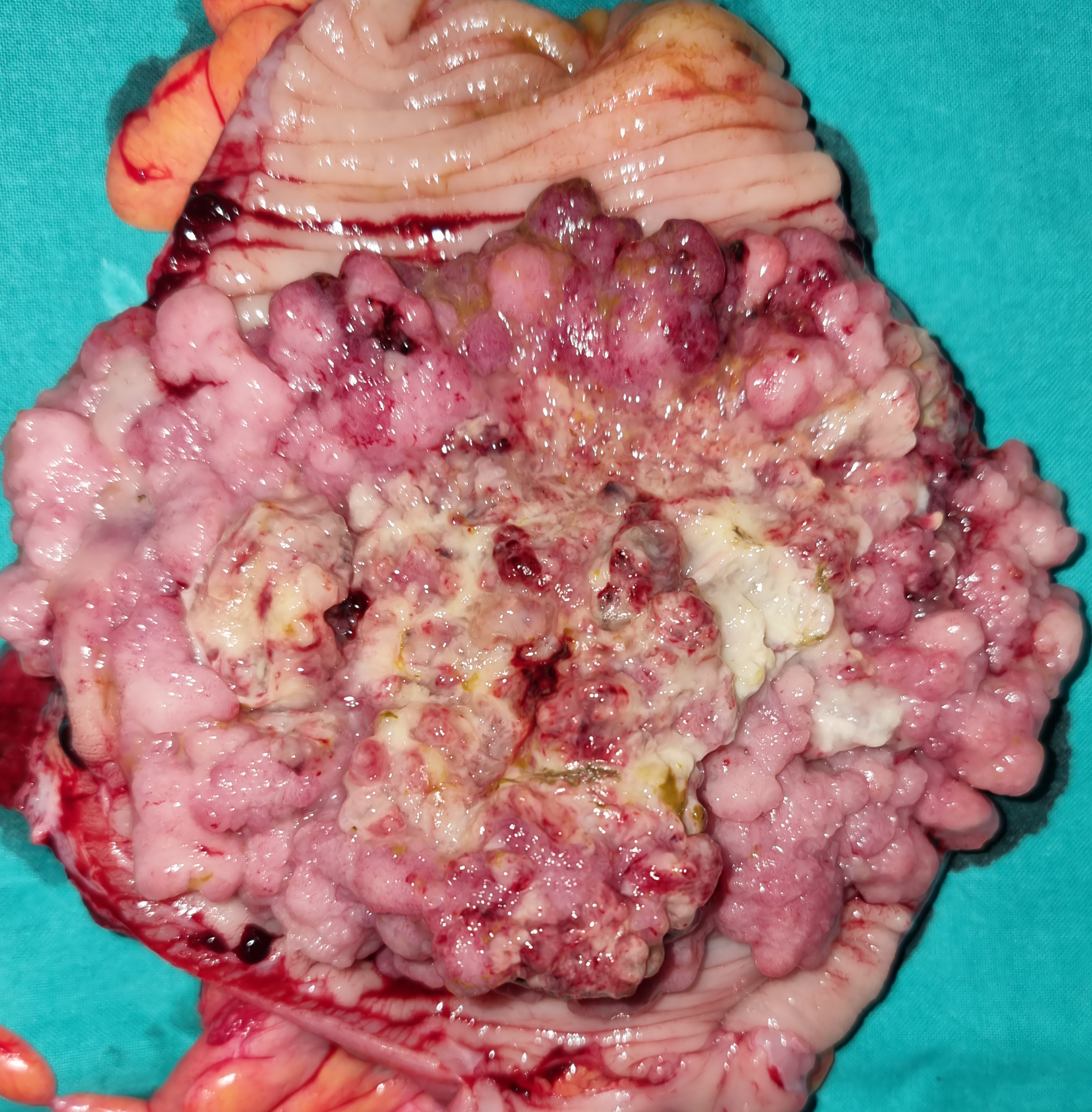 CAULIFLOWER CECAL CARCINOMA