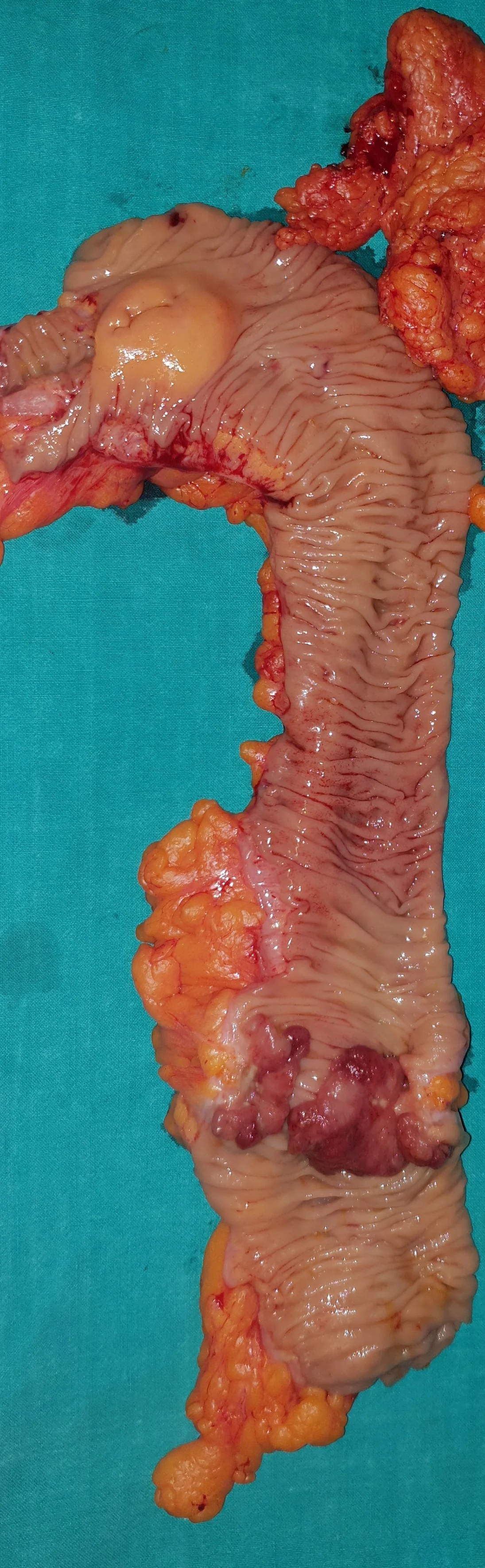 DESCENDING COLON CARCINOMA