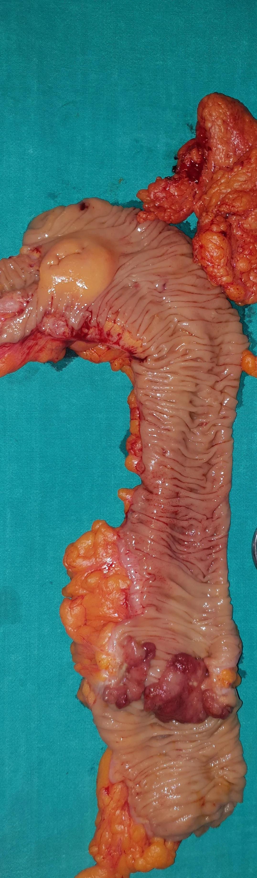 RECTAL CARCINOMA