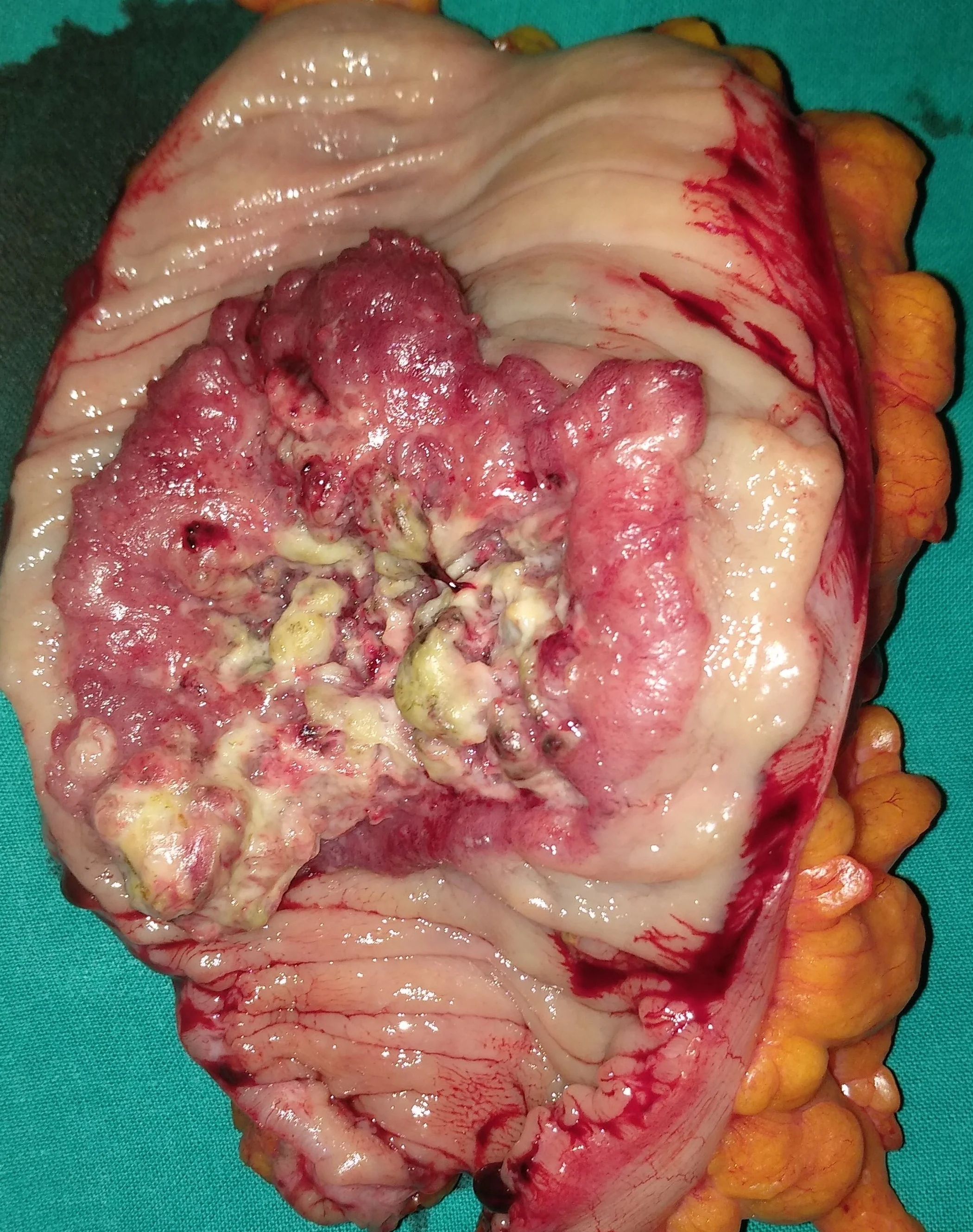 CAULIFLOWER SIGMOID CARCINOMA