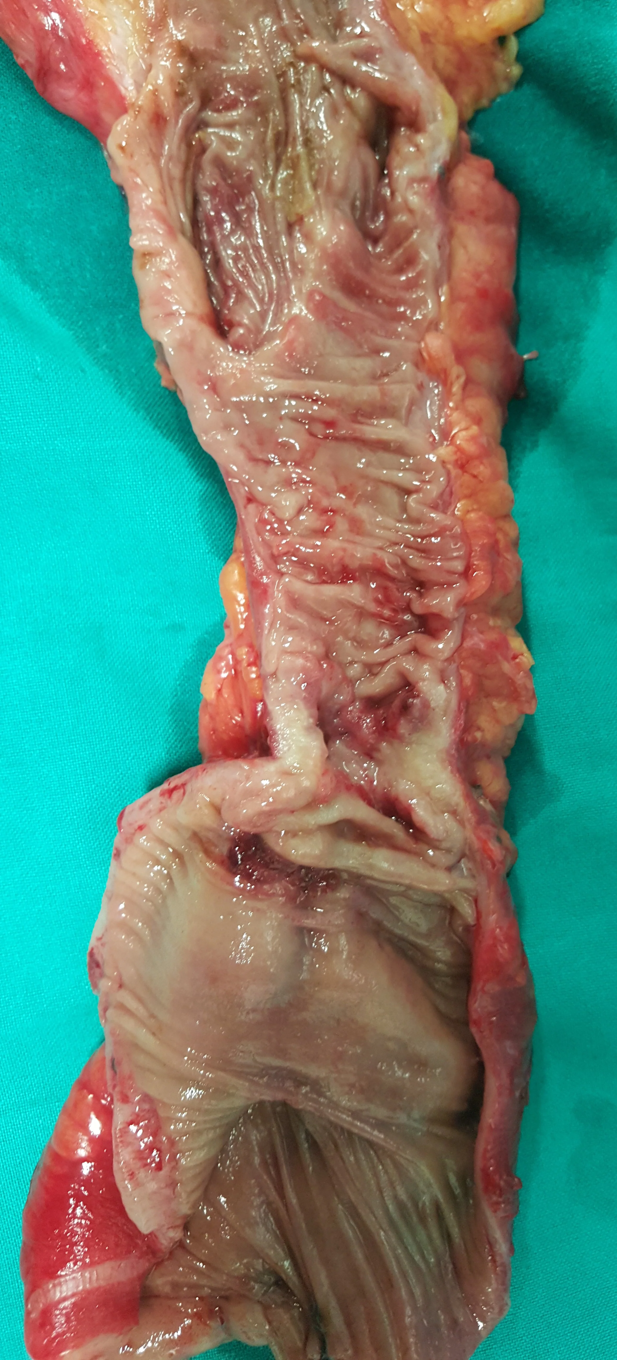 RECTAL CARCINOMA