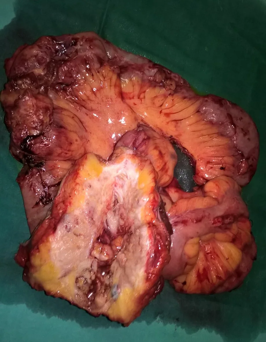RECURRENCE RECTAL CARCINOMA