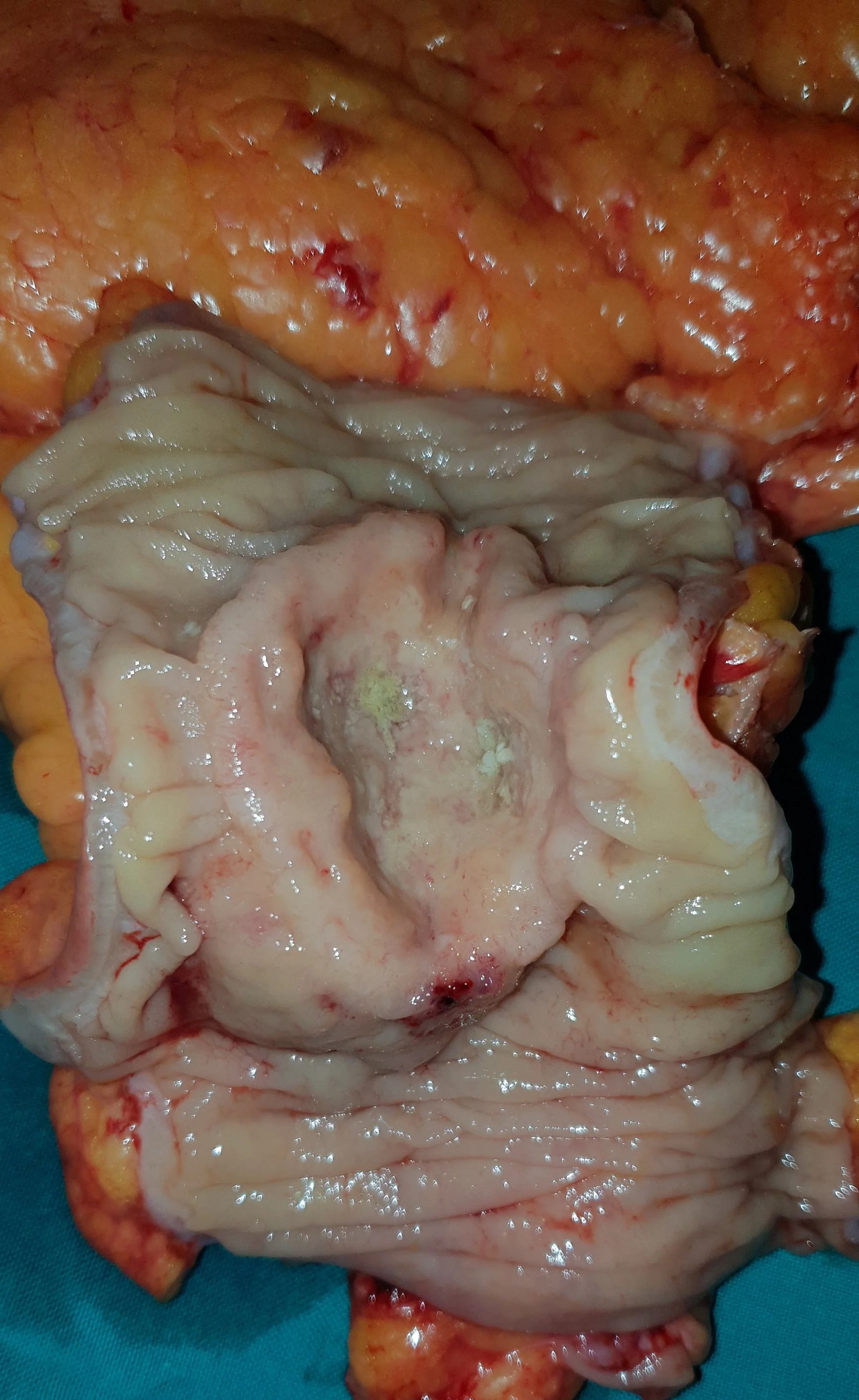 CRATER-LIKE TRANSVERSE COLON CARCINOMA