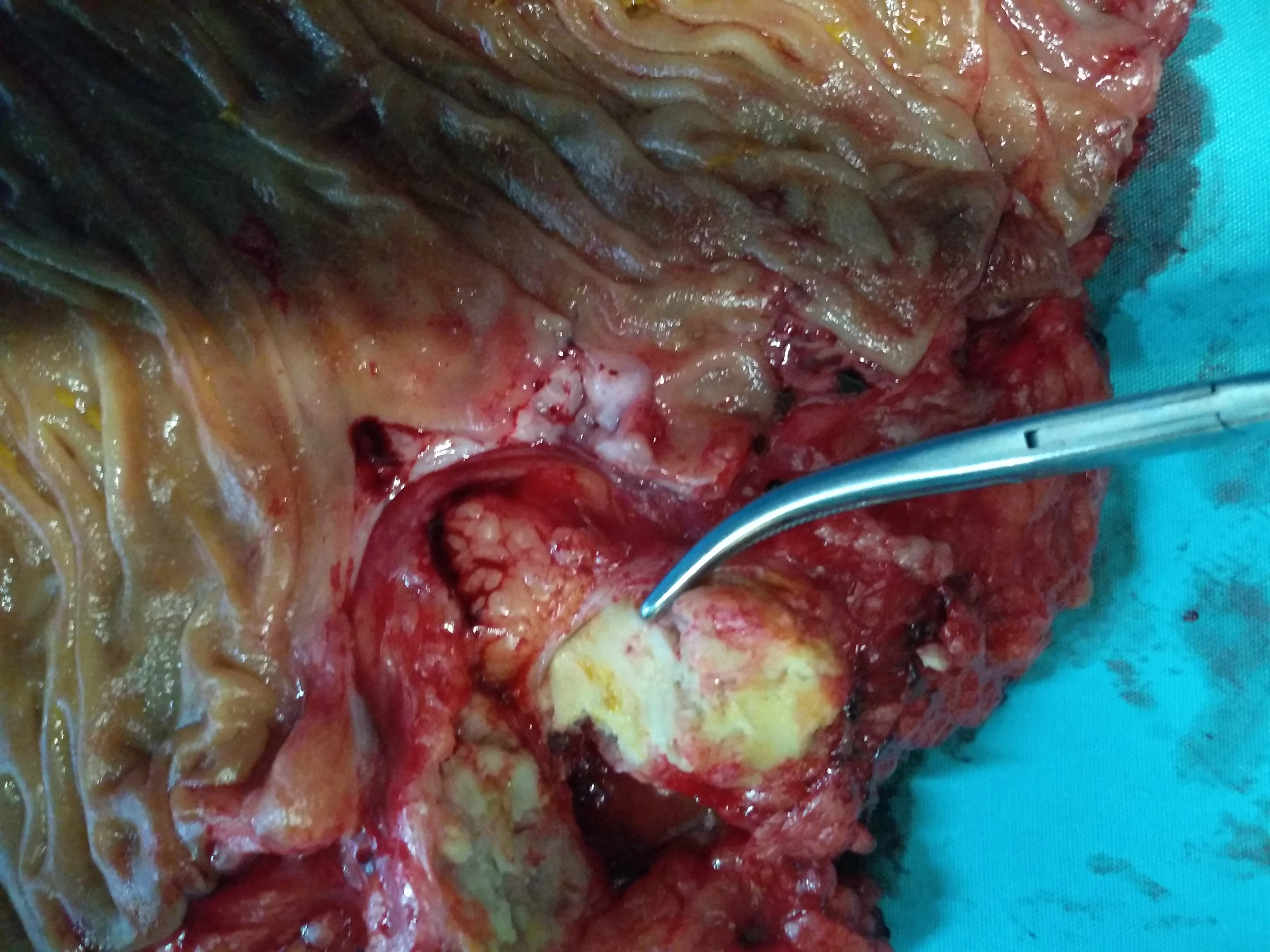 RECURRENCE RECTAL CARCINOMA