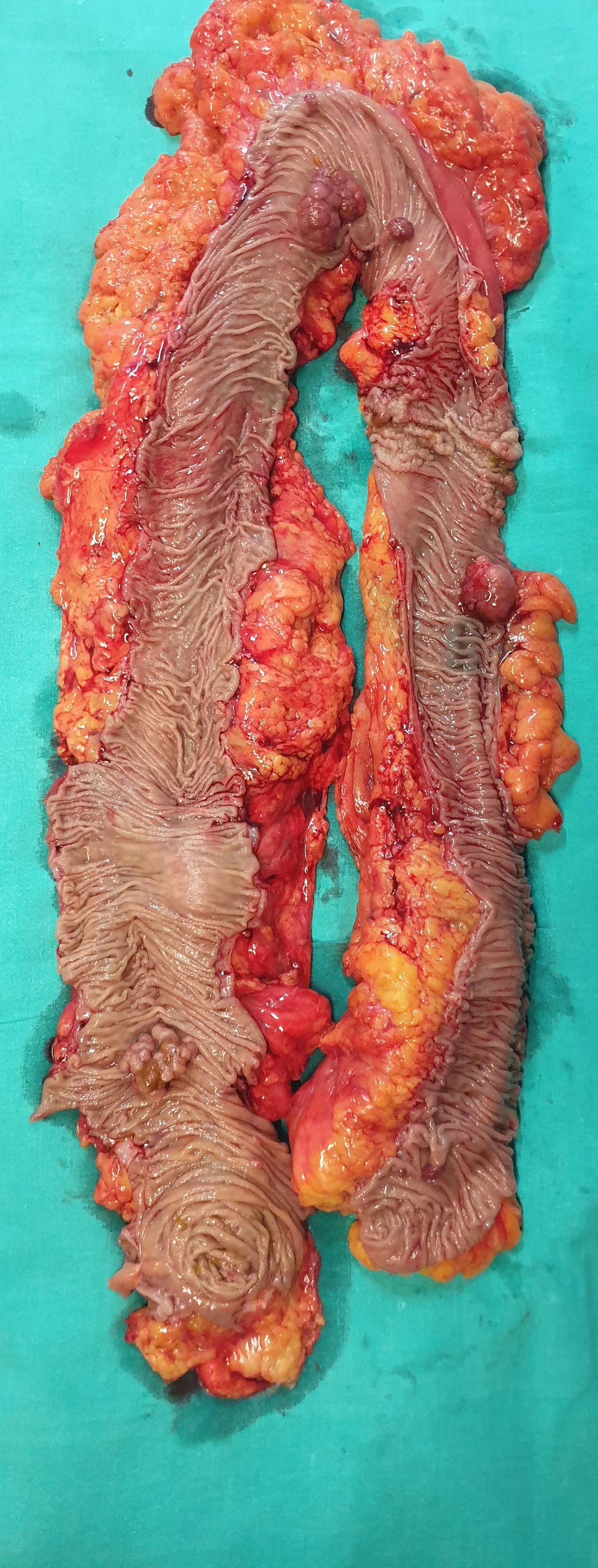 MULTIPLE COLONIC TUMORS - SUBTOTAL COLECTOMY