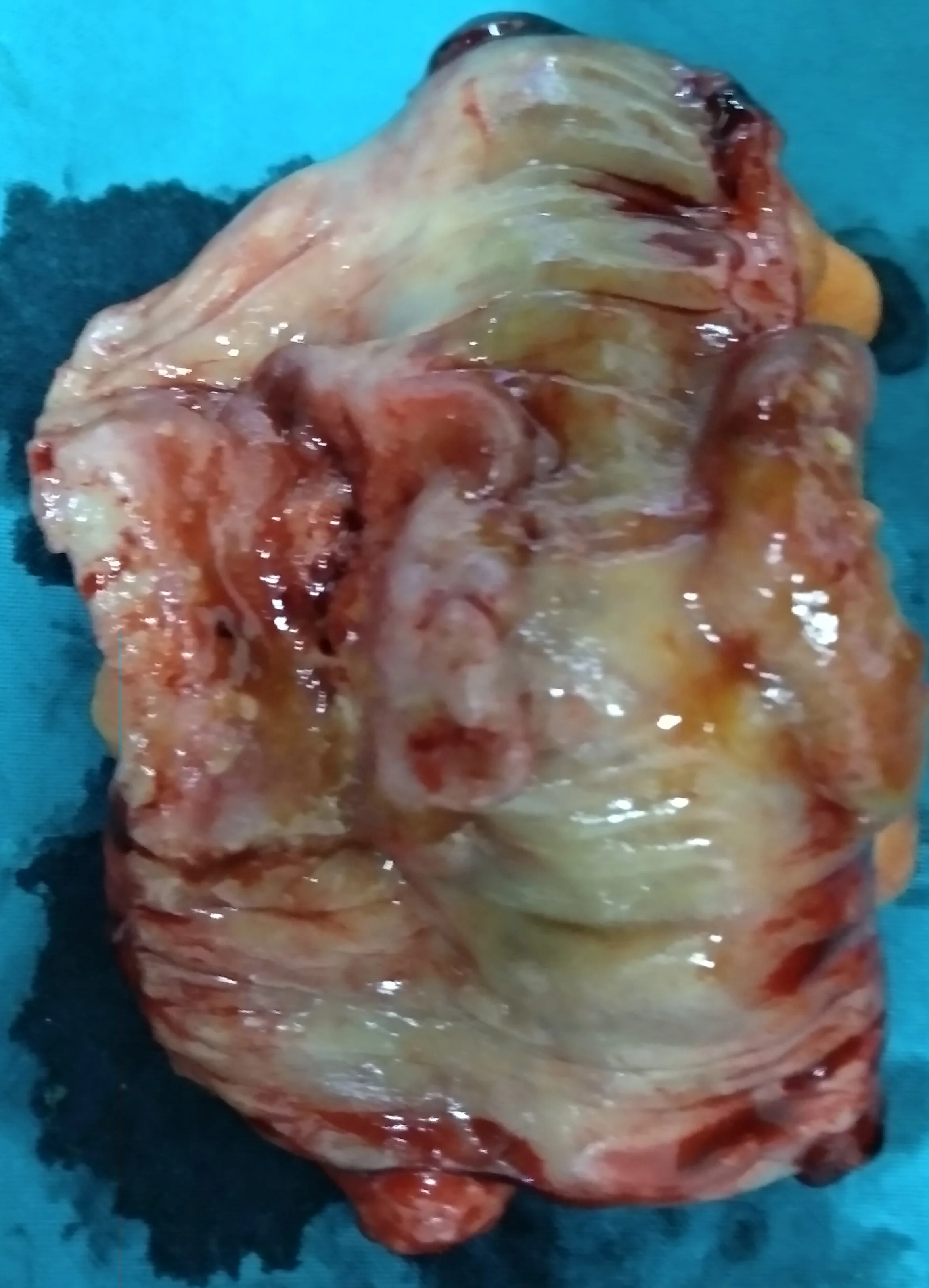 ULCERATED SIGMOID COLON CARCINOMA