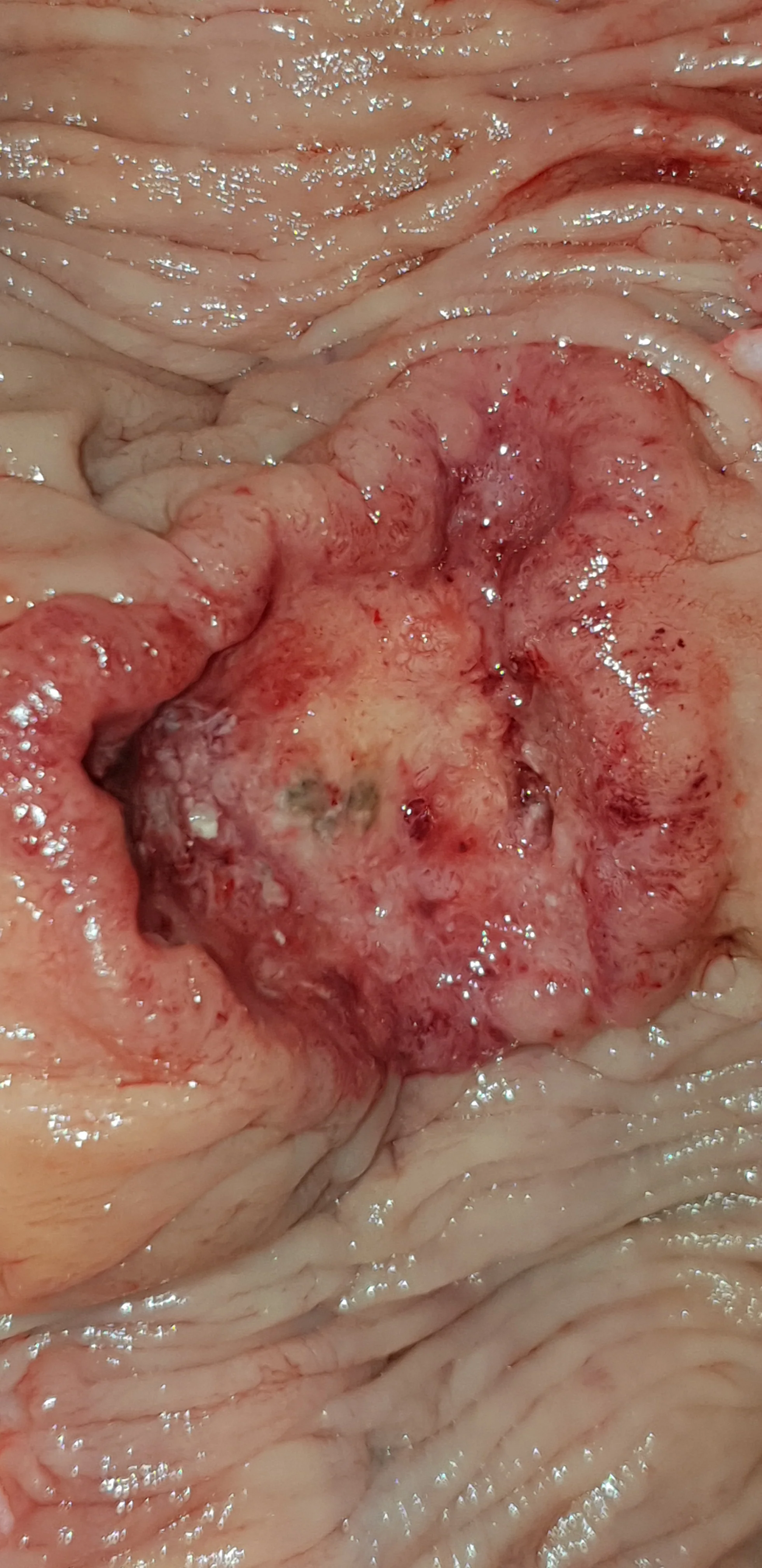 NET ILEOCECAL VALVE