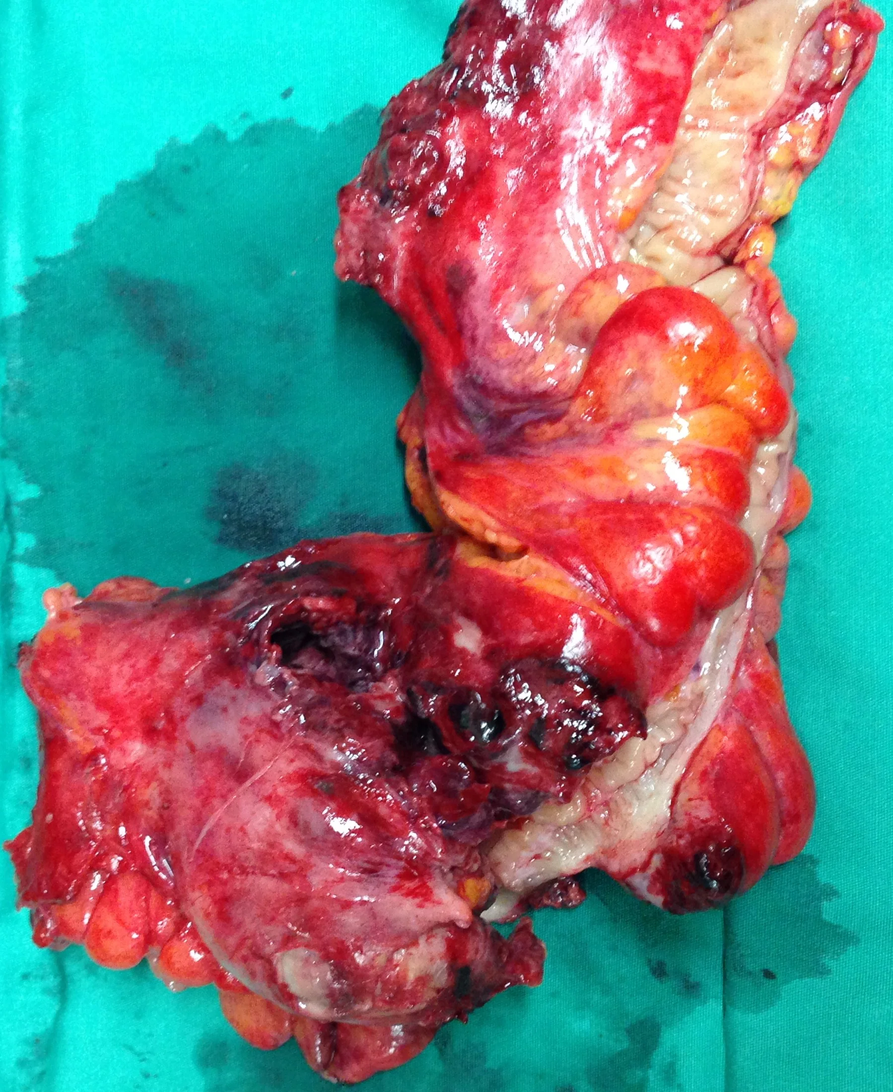 DIVERTICULAR DISEASE - ABSCESS FORMATION
