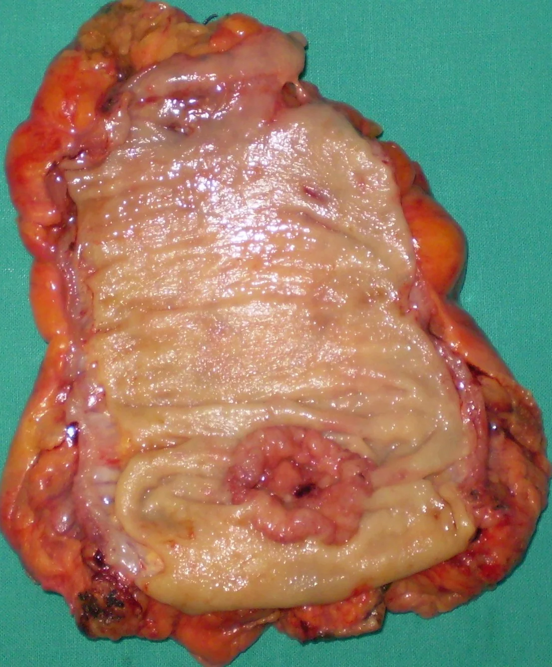 RECTAL CARCINOMA