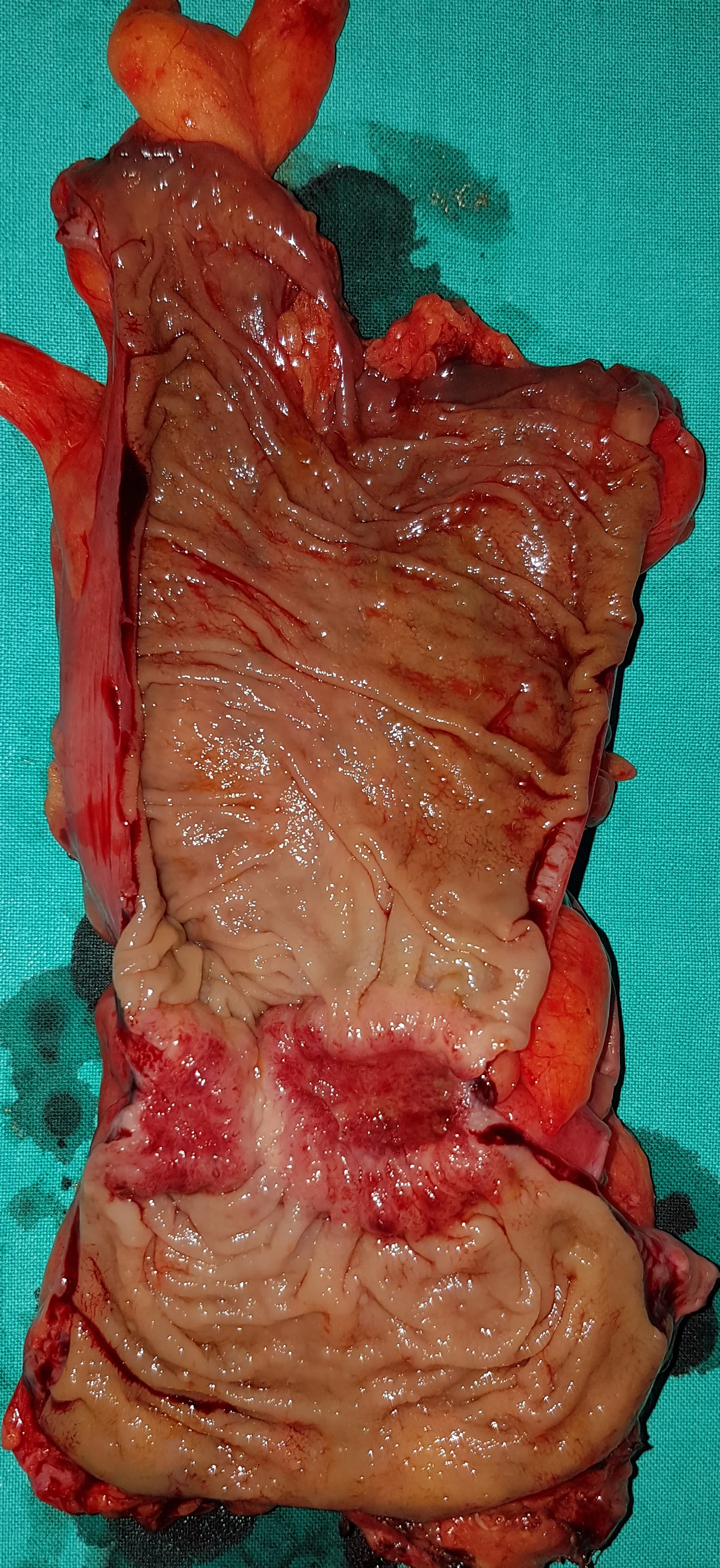 RECTAL CARCINOMA