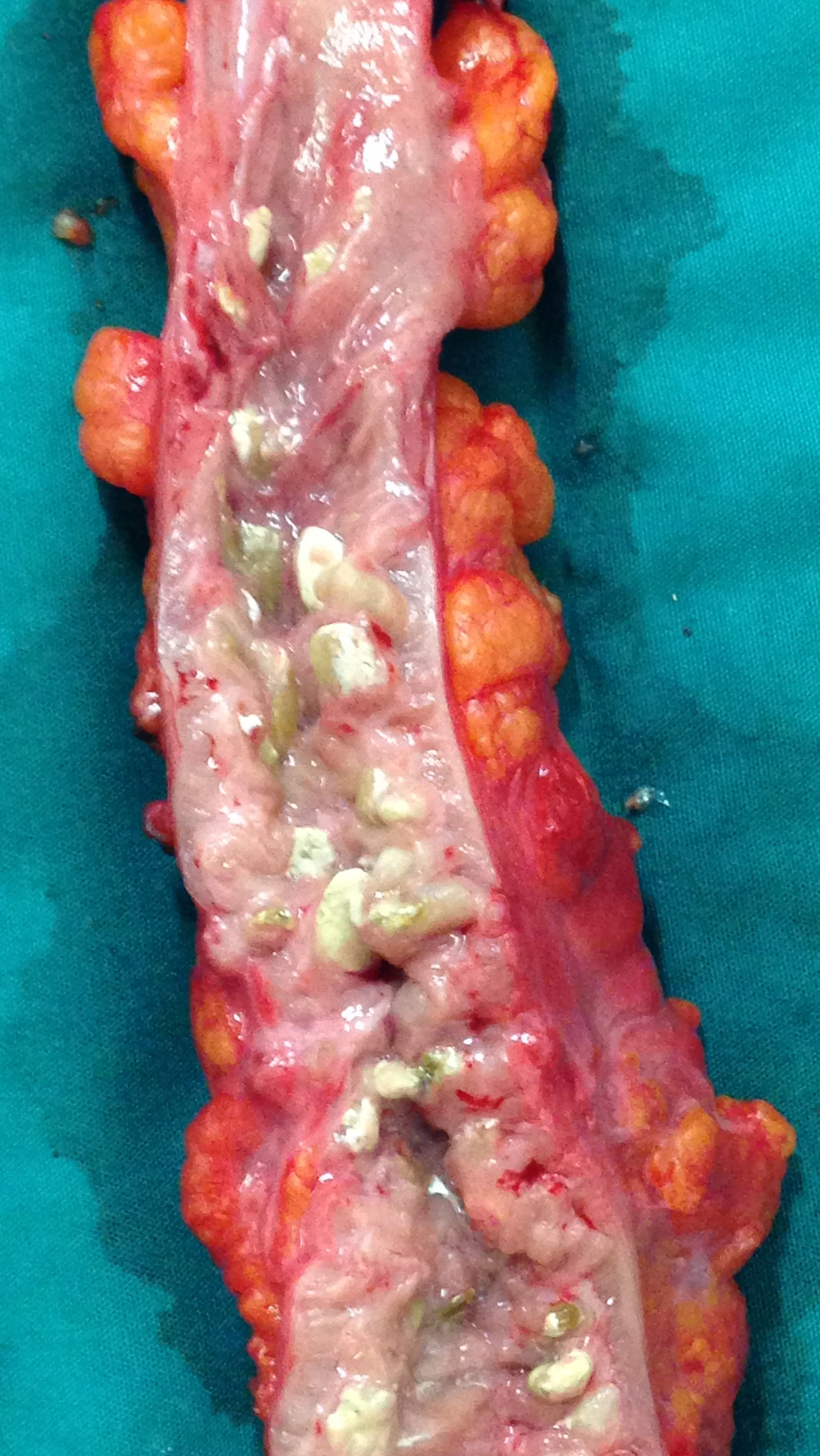 DIVERTICULA DISEASE