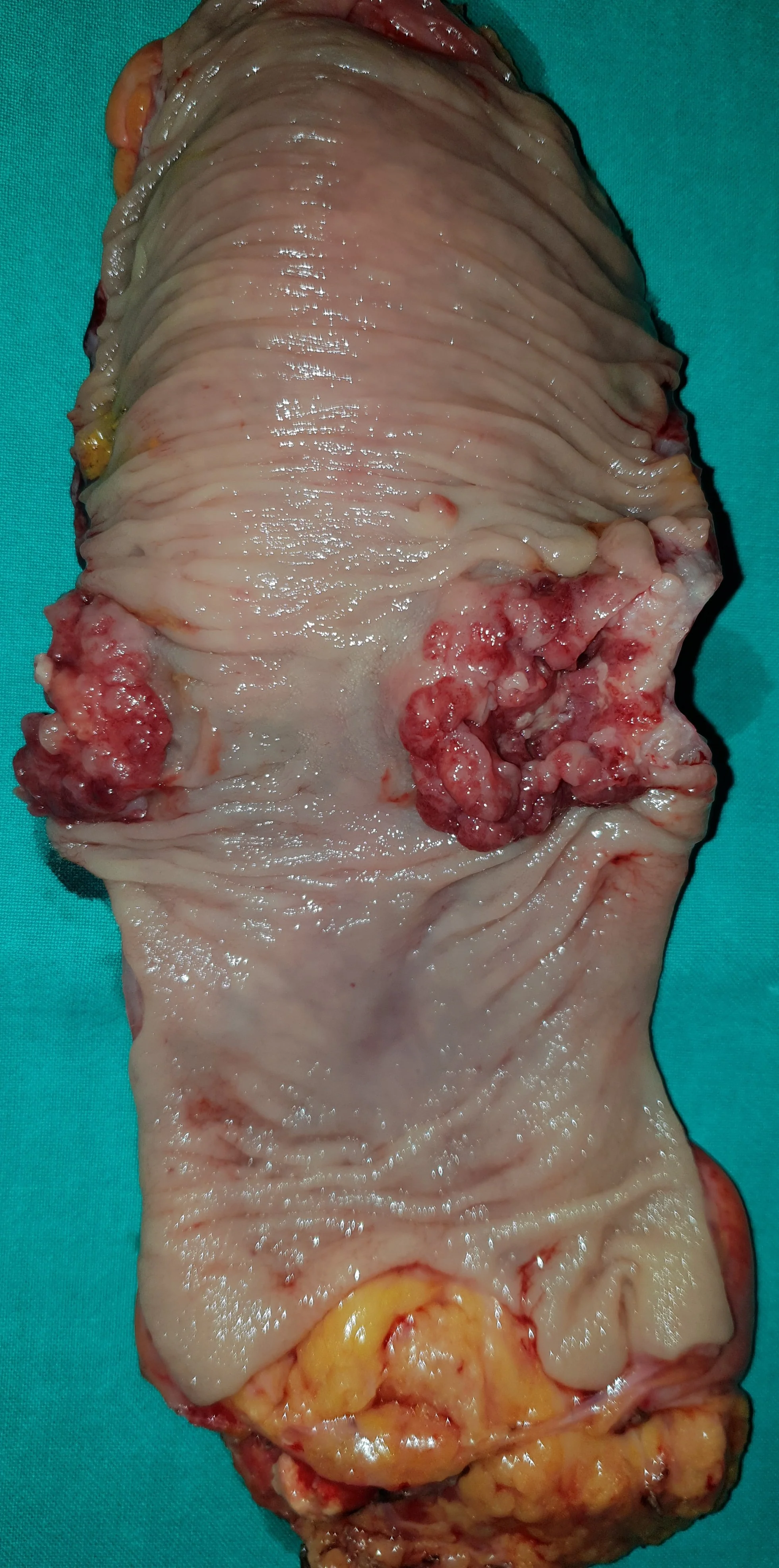 RECTAL CARCINOMA