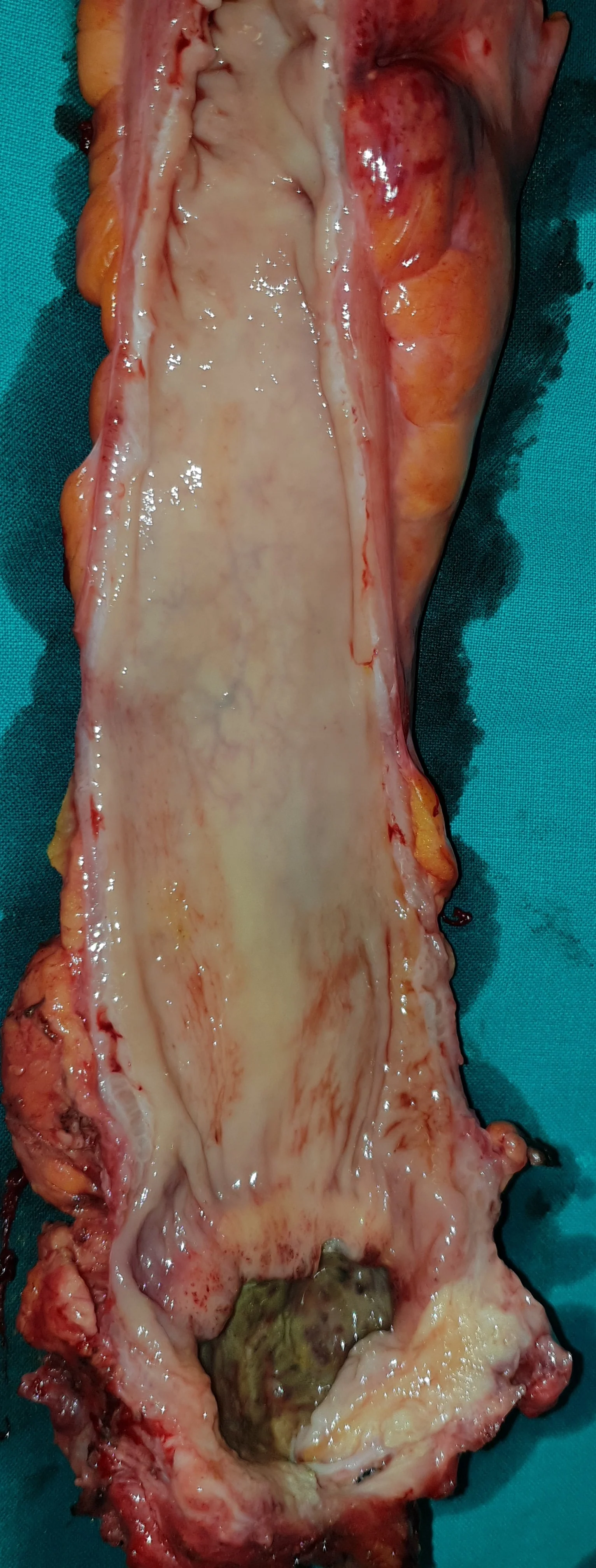 RECTAL CARCINOMA