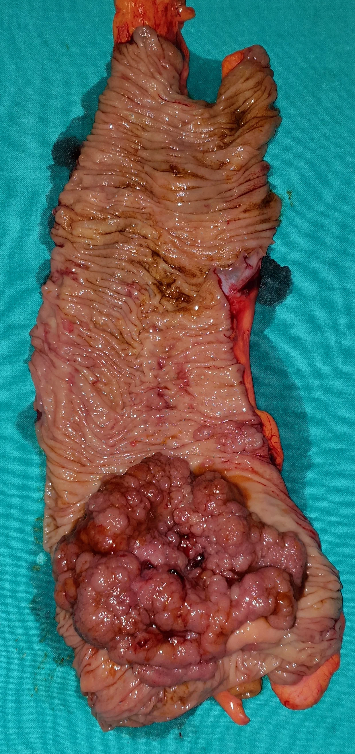 BENIGN VILLOUS ADENOMA