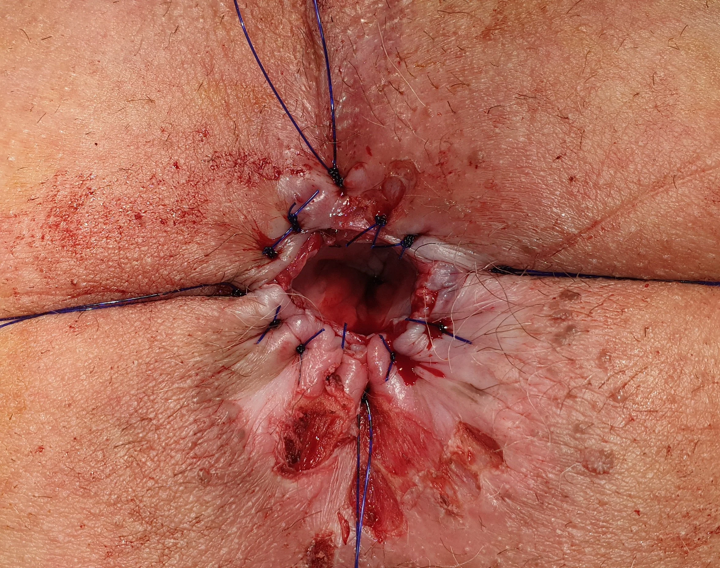 ANAL STENOSIS REPAIR