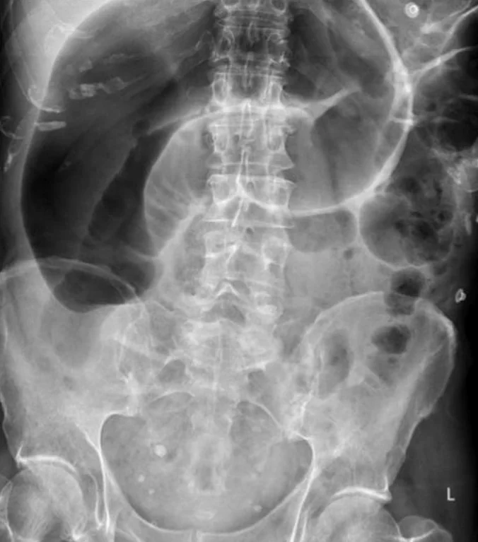 CECAL VOLVULUS