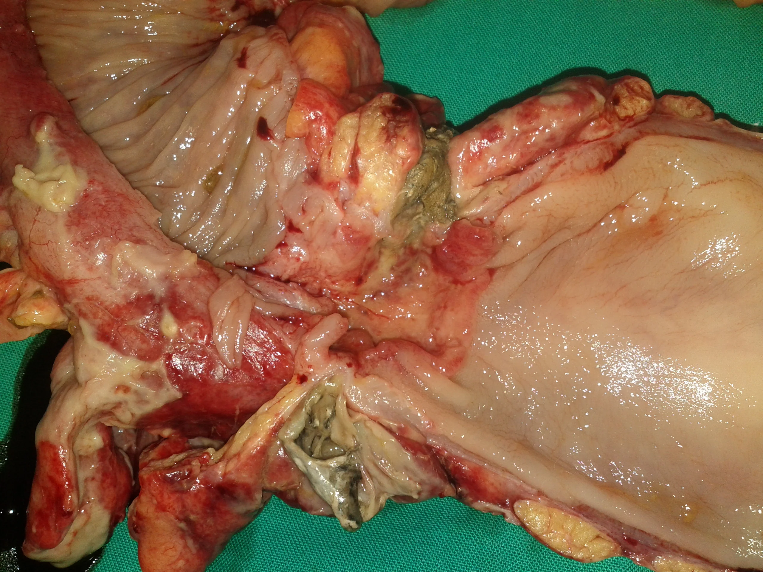 COLONIC DIVERTICULUM PERFORATION AND SIGMOID COLON CARCINOMA
