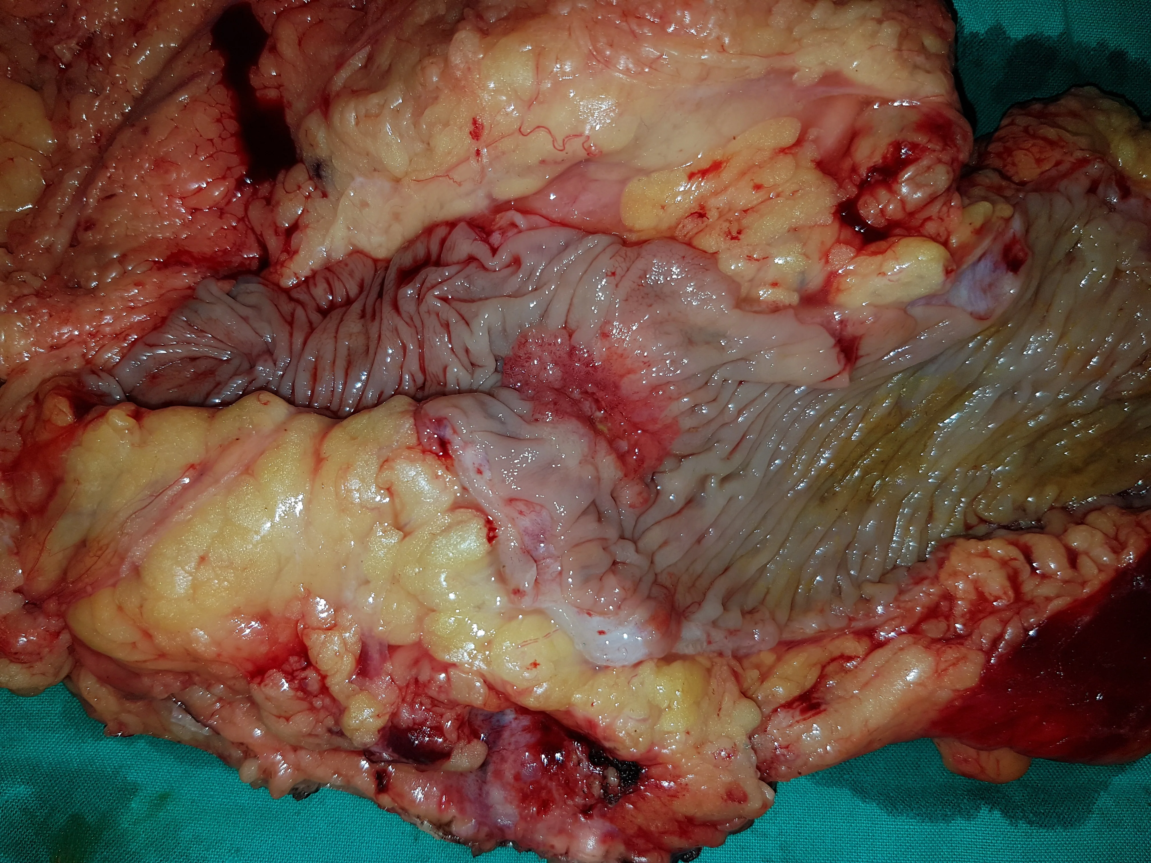TRANSVERSE COLON CARCINOMA