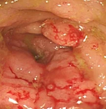 NEUROENDOCRINE COLONIC TUMOR