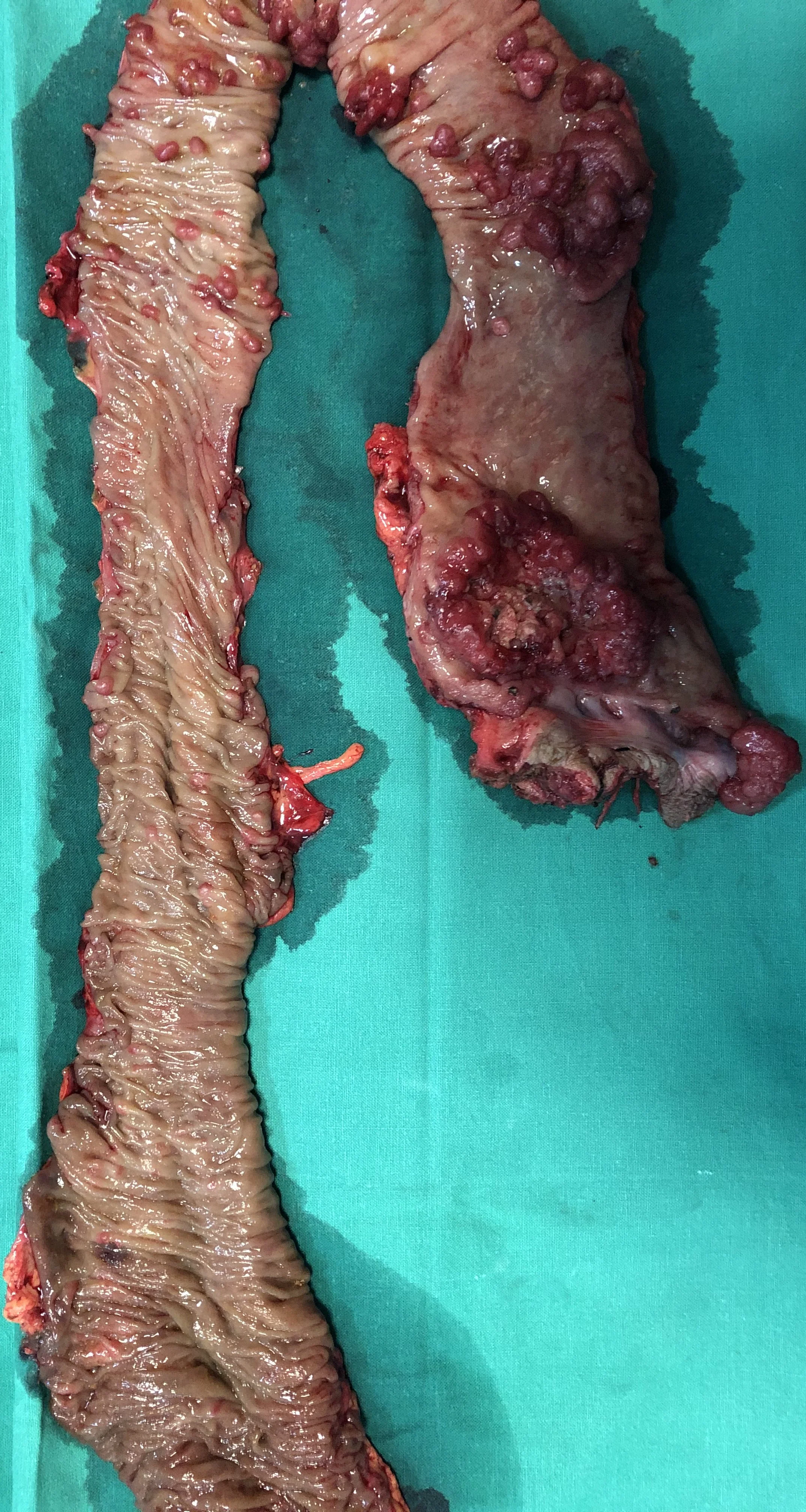 SYNCHRONOUS COLONIC CARCINOMAS