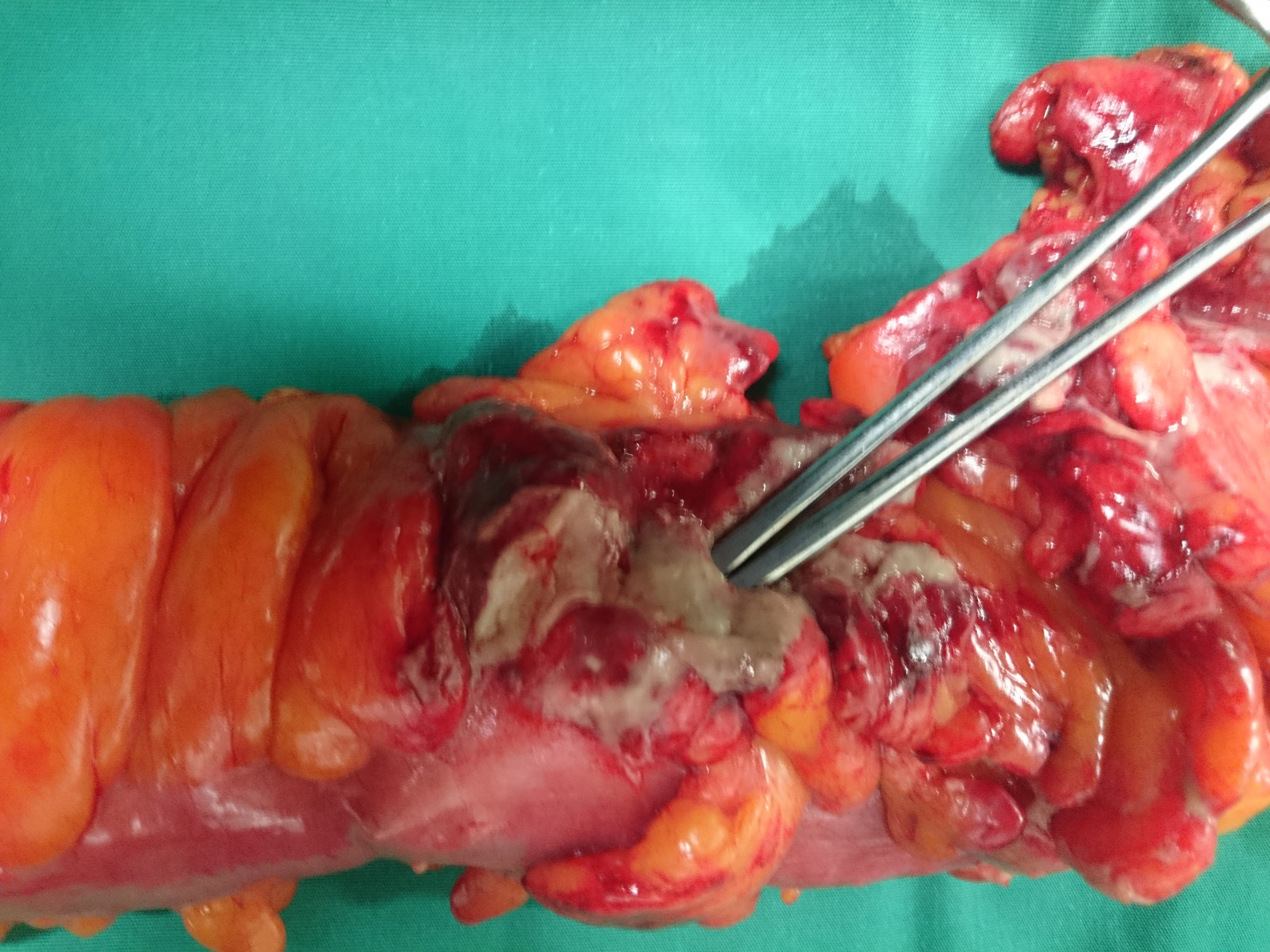 SIGMOID PERFORATION - STEROIDS