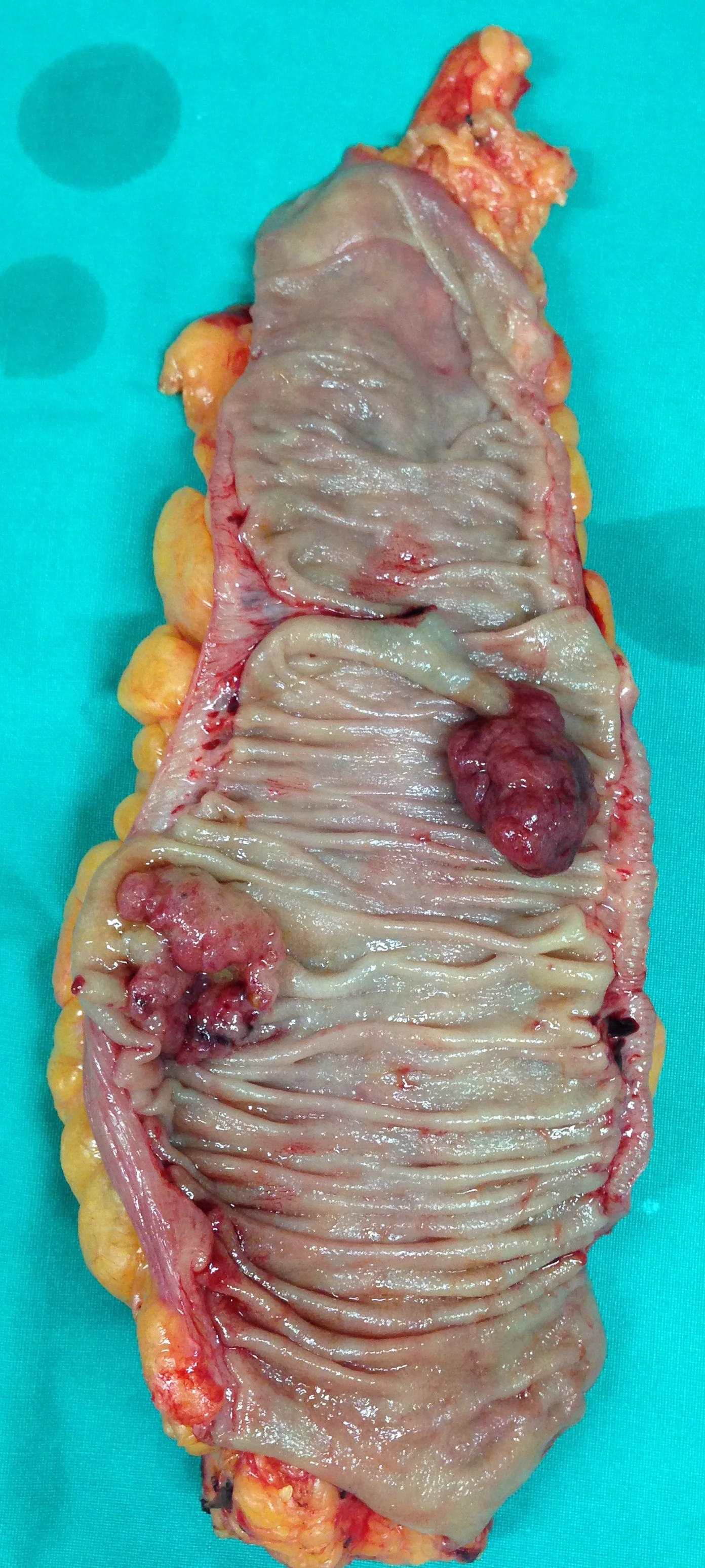 SYNCHRONOUS SIGMOID CARCINOMAS