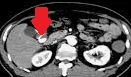BLEEDING DIVERTICULUM