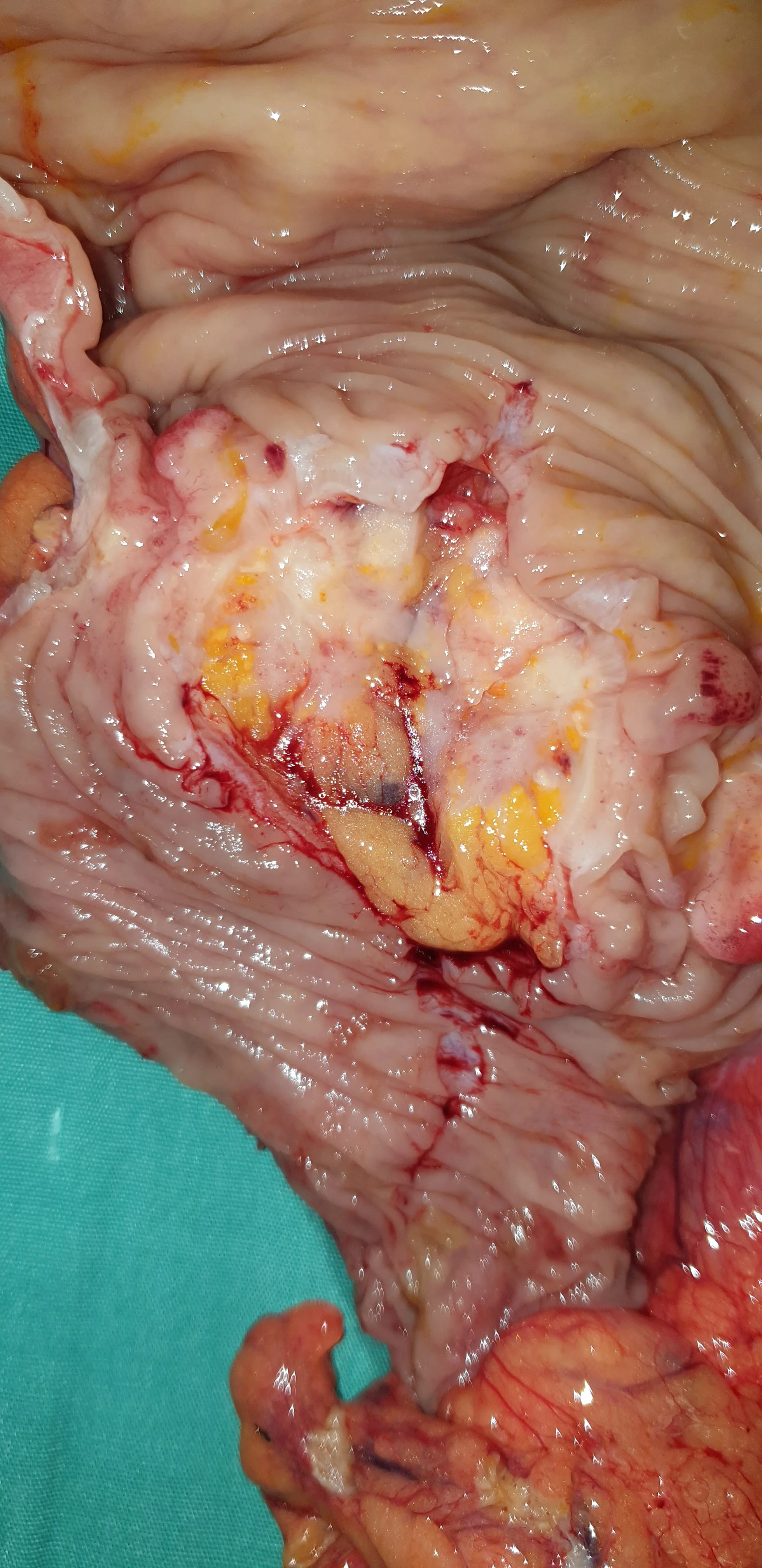 RECURRENCE RECTAL CARCINOMA