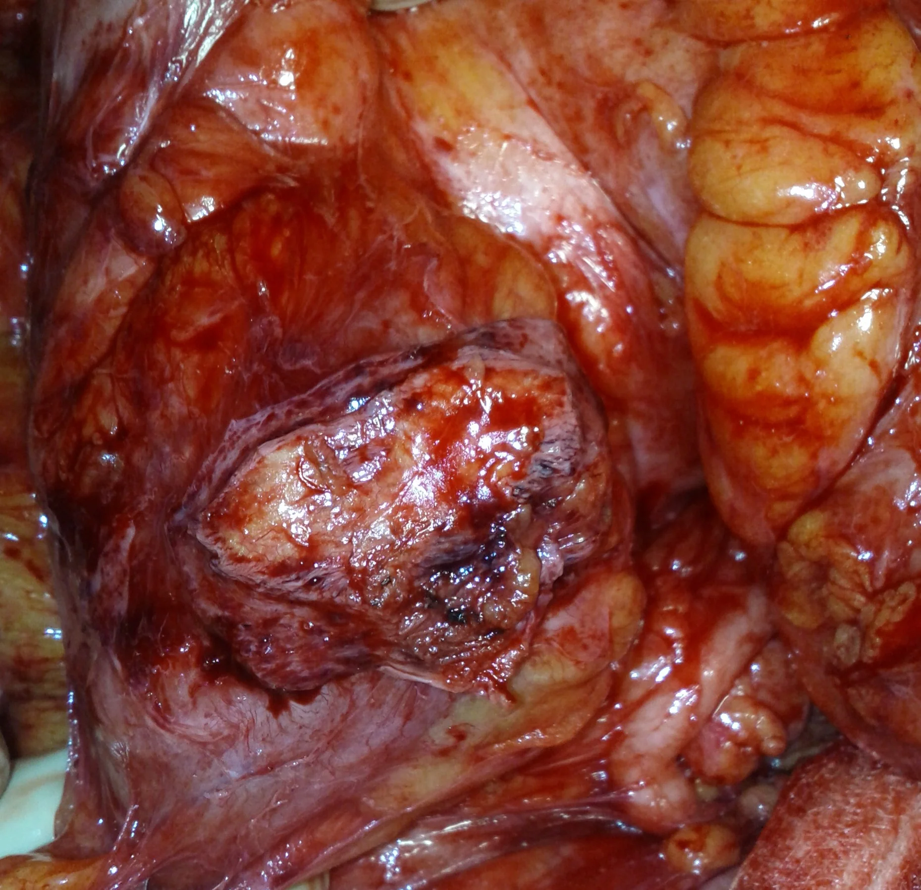 RECCURENCE RECTAL CARCINOMA