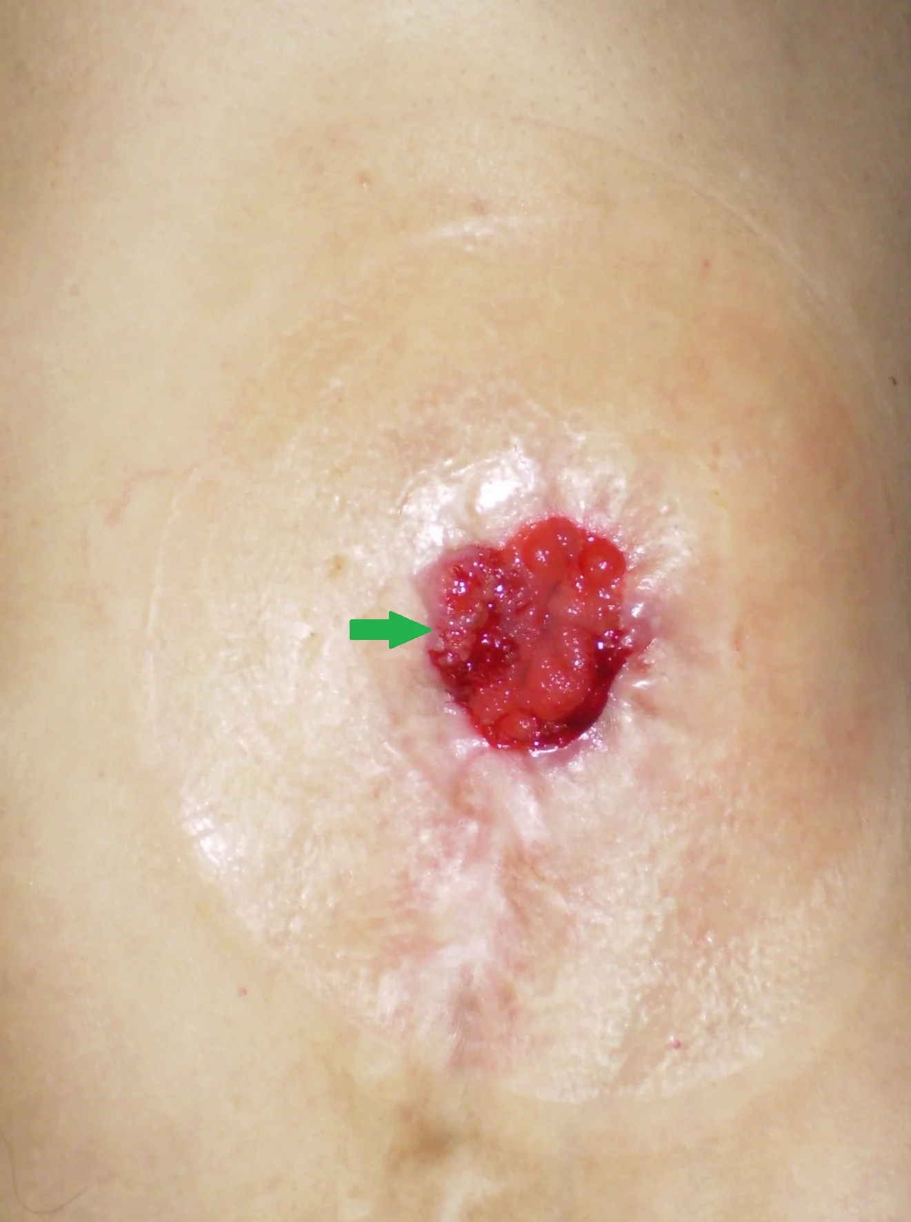 COLOSTOMY RECURRENCE