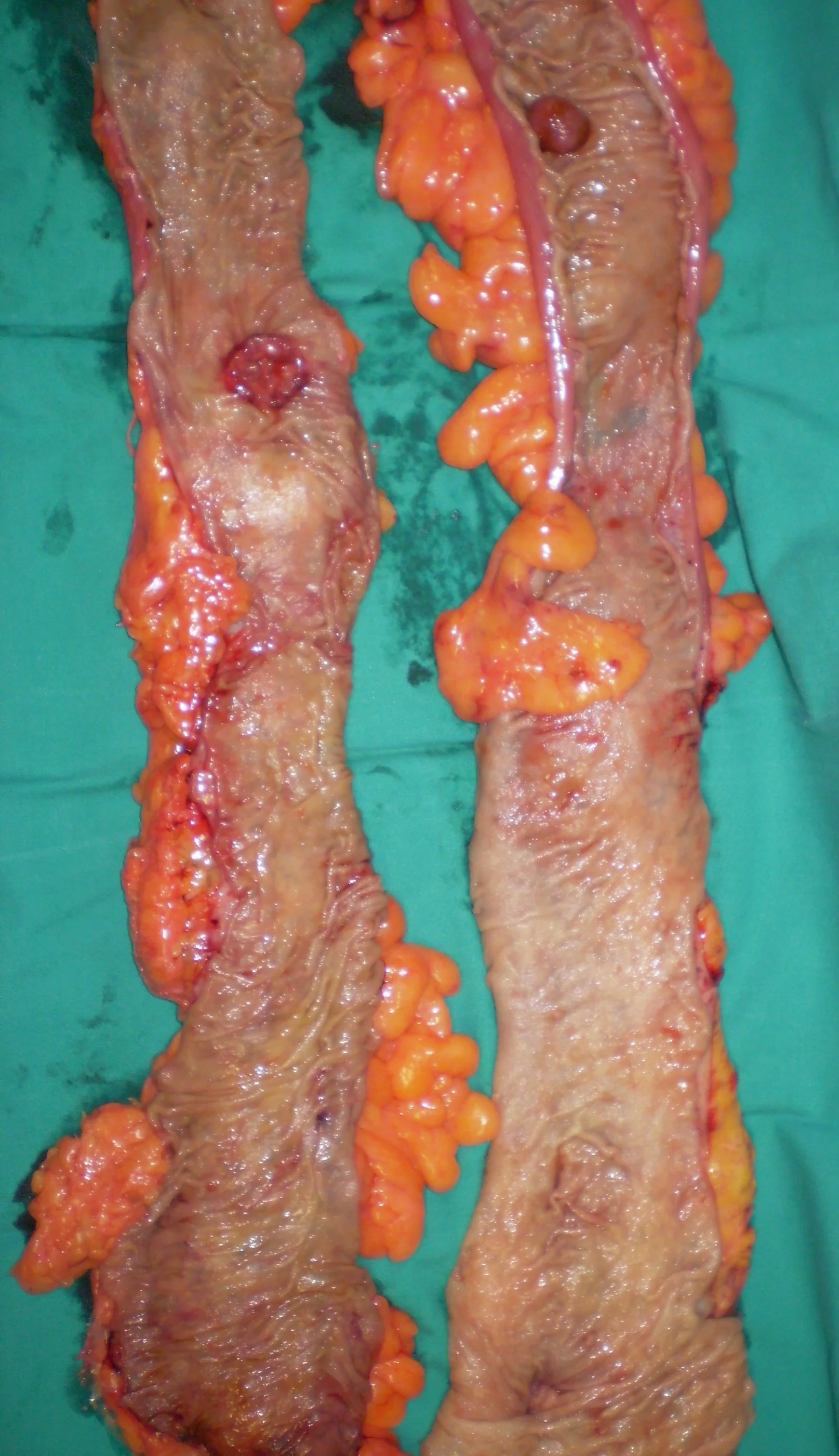 SYNCHRONOUS COLONIC CARCINOMAS