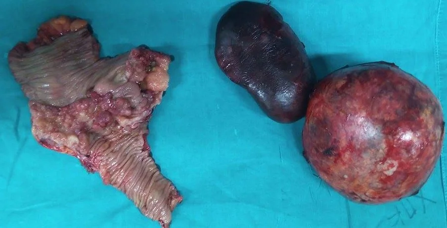 SYNCHRONOUS CECAL CARCINOMA AND PARA-ADRENAL PARAGANGLIOMA