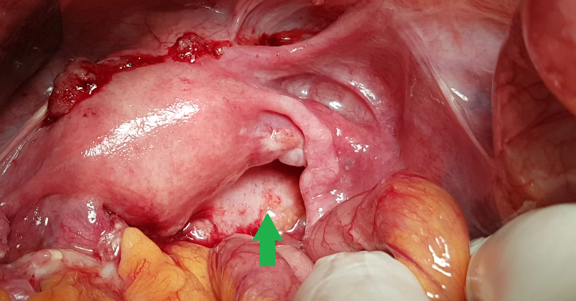 RECURRENCE RECTAL CARCINOMA
