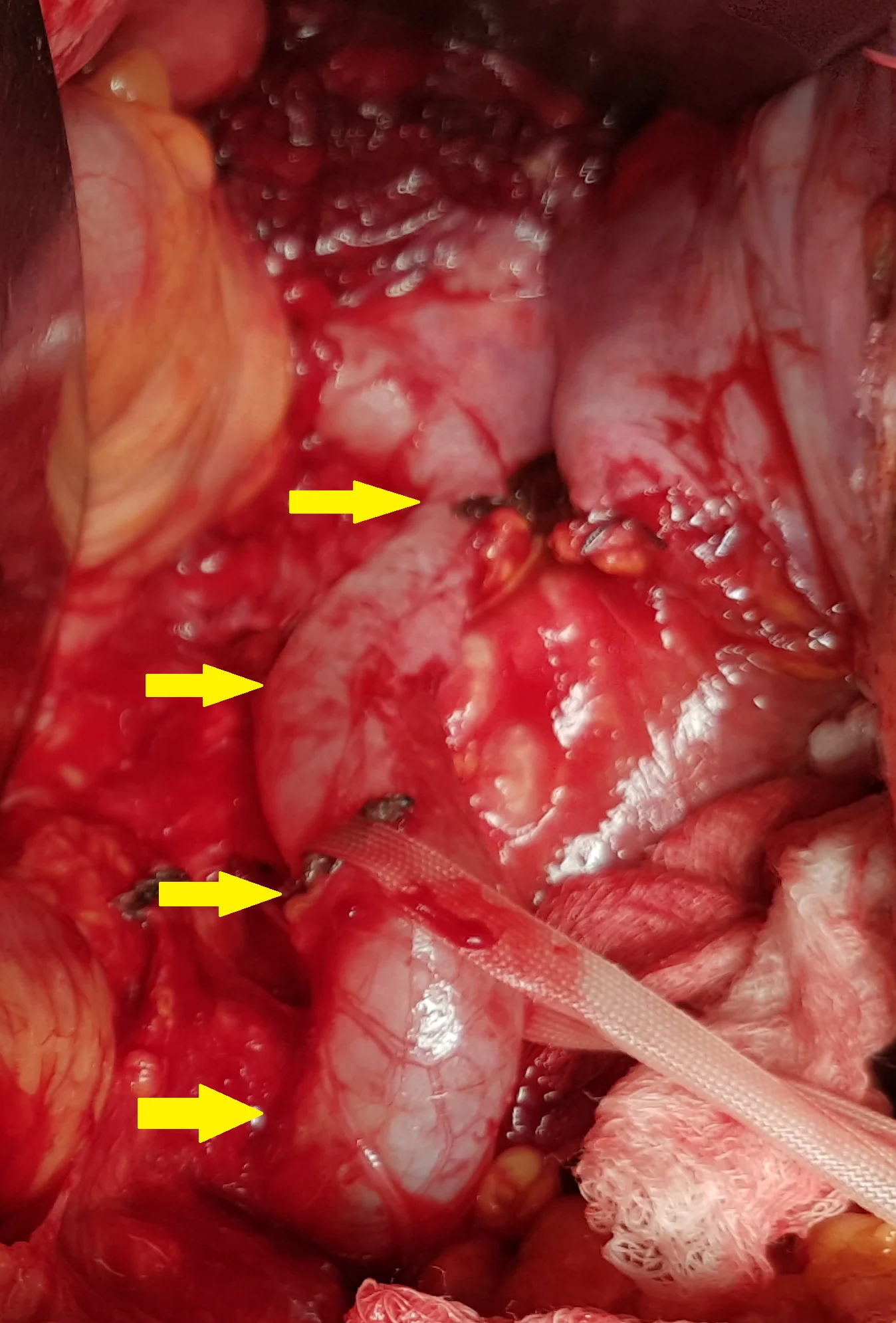 RECURRENCE RECTAL CARCINOMA - DILATED LEFT URETER