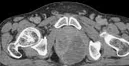 ANORECTAL ABSCESS