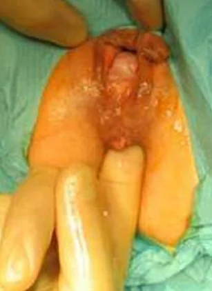 ANTERIOR RECTOCELE