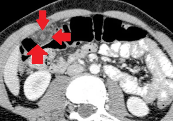 EPIPLOIC APPENDAGITIS